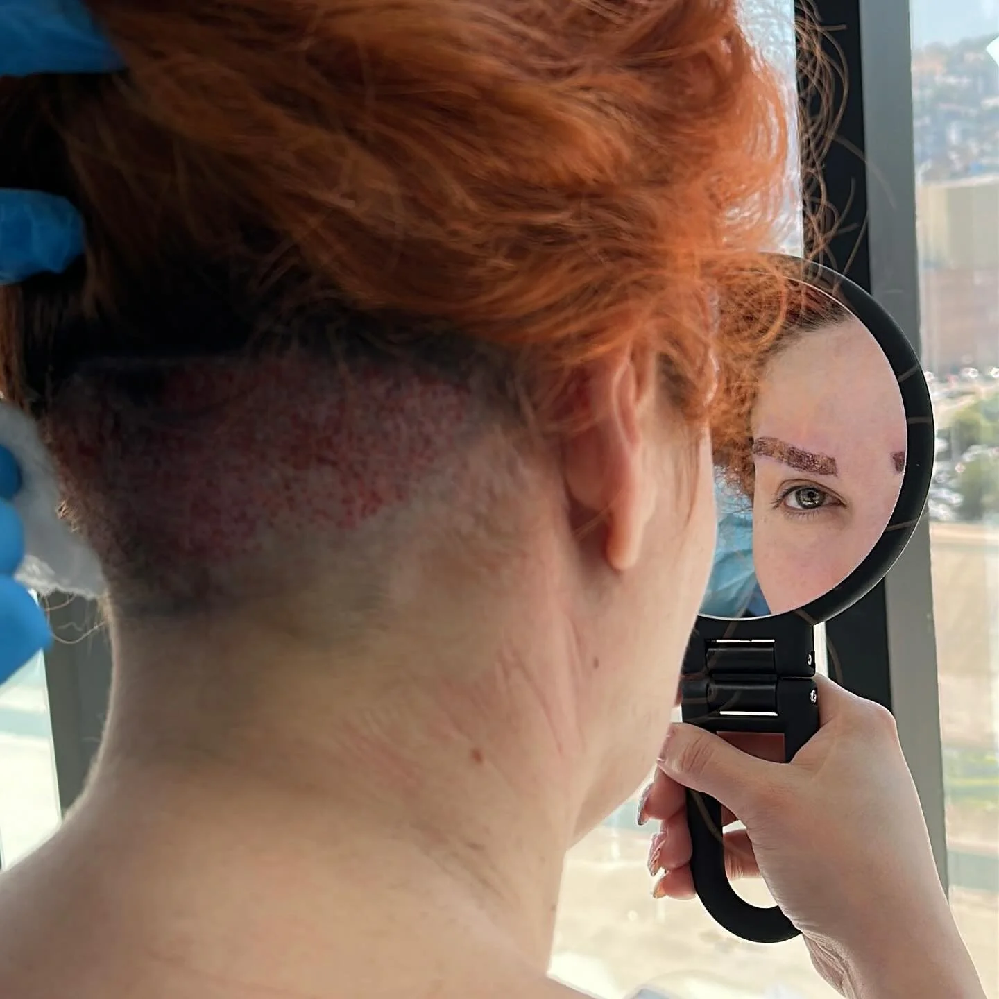 UNDERCUT is my all time favorite for 
Eyebrow Transplant Surgery 💪🏻

And now we wait 🌱