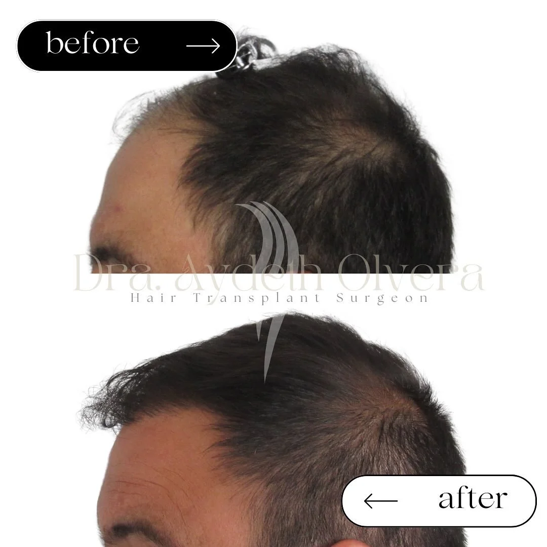 Hair Transplant Surgery 
U P D A T E ✨🤌🏻

Male patient
Androgenetic Alopecia
Norwood IIIb
No Oral Treatment prior surgery
Goals: 
- Density to frontal area

Grafts: 1894
Hairs: 4545
Ratio: 2.4

✨🤟🏻