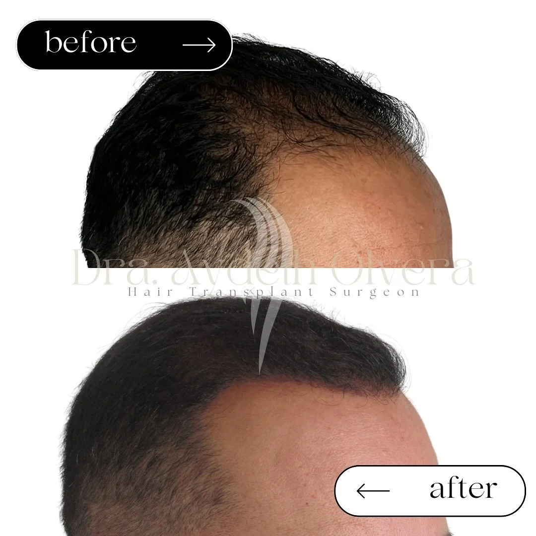 1 year Hair Transplant Surgery
U P D A T E ✨

Hair loss is something you CAN take control off, before its too late 💪🏻

Book your appointment TODAY!