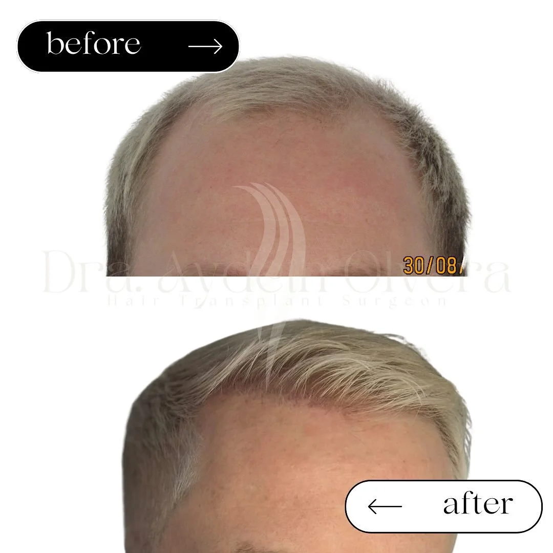 1 YEAR
Hair Transplant Surgery
U P D A T E ✨

Male patient
34 years old
Androgenetic Alopecia
Norwood IIIb
No previous hair treatments

Grafts 2854
Hairs 6270
Ratio 2.1

Its never too late to fix your confidence 💪🏻

DM for a free hair consultation 
