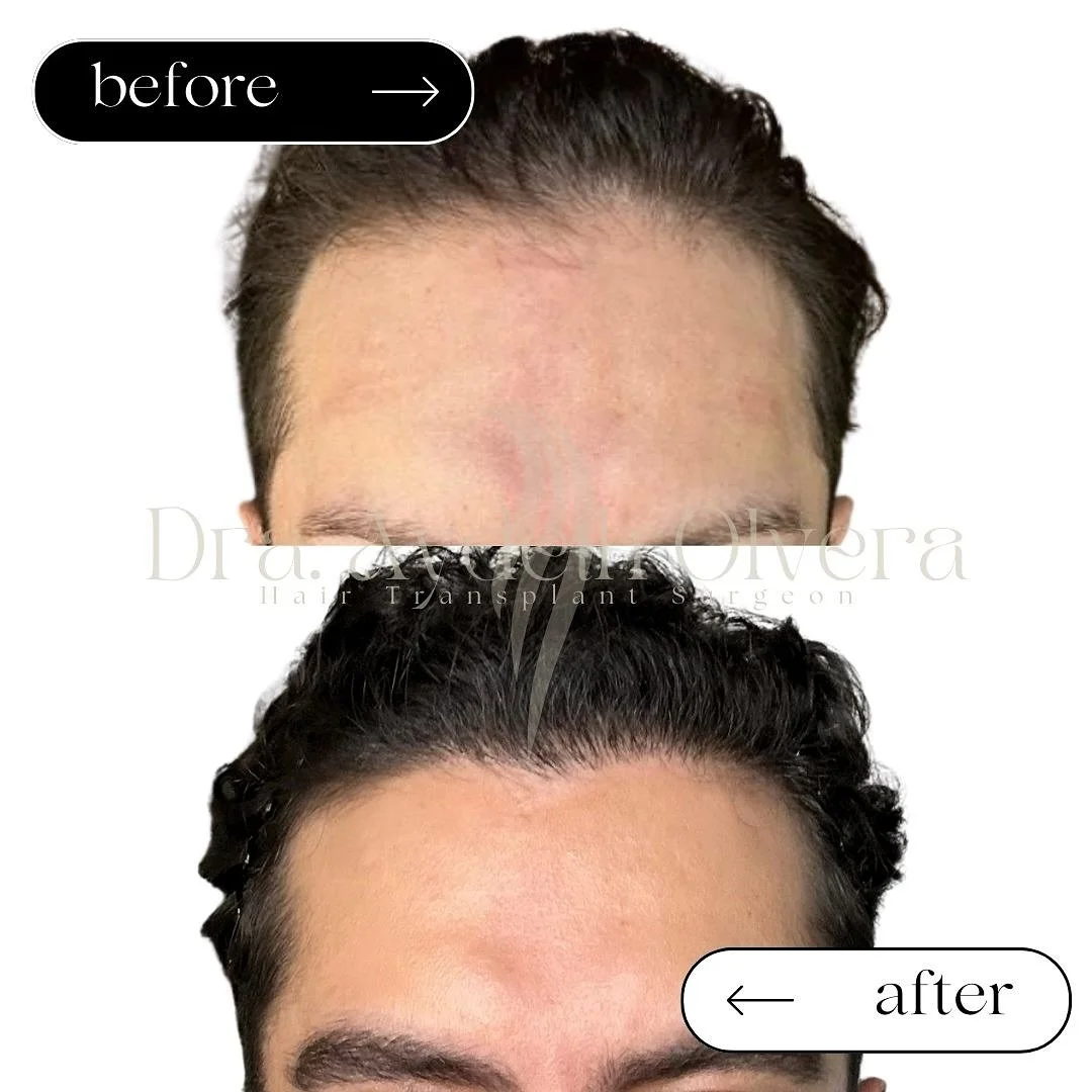 6 MONTH UPDATE
Hairline Enhancement with
Hair Transplant Surgery
+ Hair treatment ✨

In this particular patient, the alopecia was barely starting, a Norwood I but, early treatments are key in young patients and the aesthetic part of my job is to add 