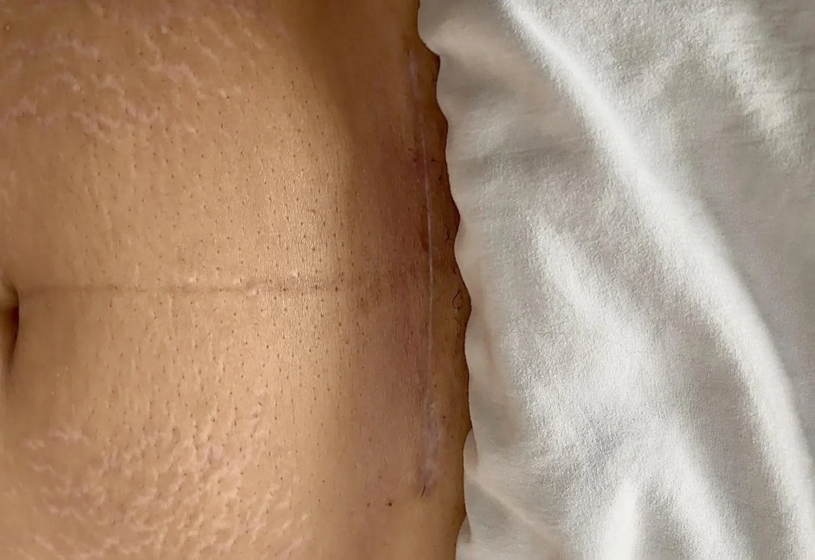 Close-up of a healed C-section scar on a woman's lower abdomen — Avonlea Brown Physical Therapy, Costa Mesa, CA.