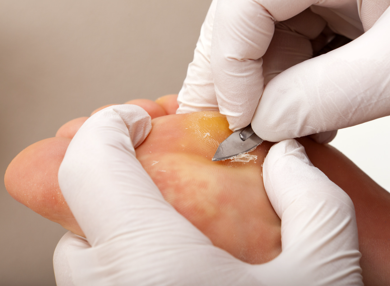 podiatrist, debridement, treatment