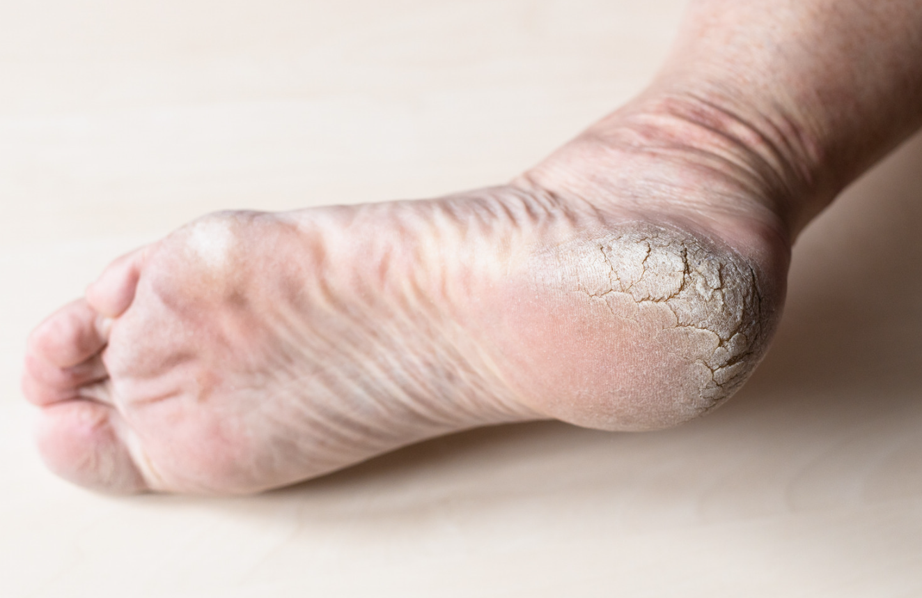 callous feet, dry heels, cracked heels