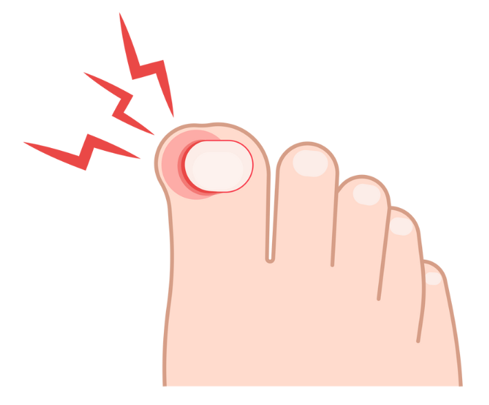 Digital illustration of a toe with an ingrown toenail causing redness and pain.