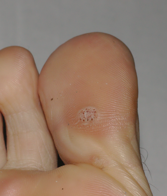 plantar wart, HPV, virus, foot infection, wart infection