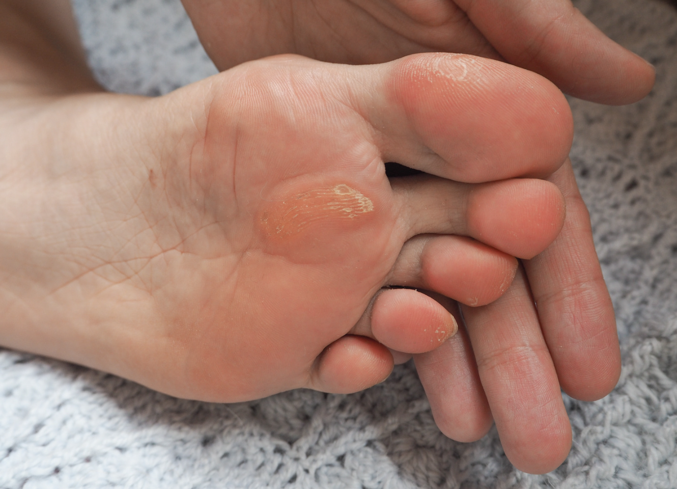 foot corn, corns on feet, painful corn