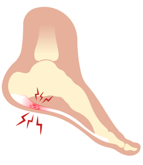 Diagram of a nose showing pain and inflammation in the nasal passages, indicating sinus pain or sinusitis.