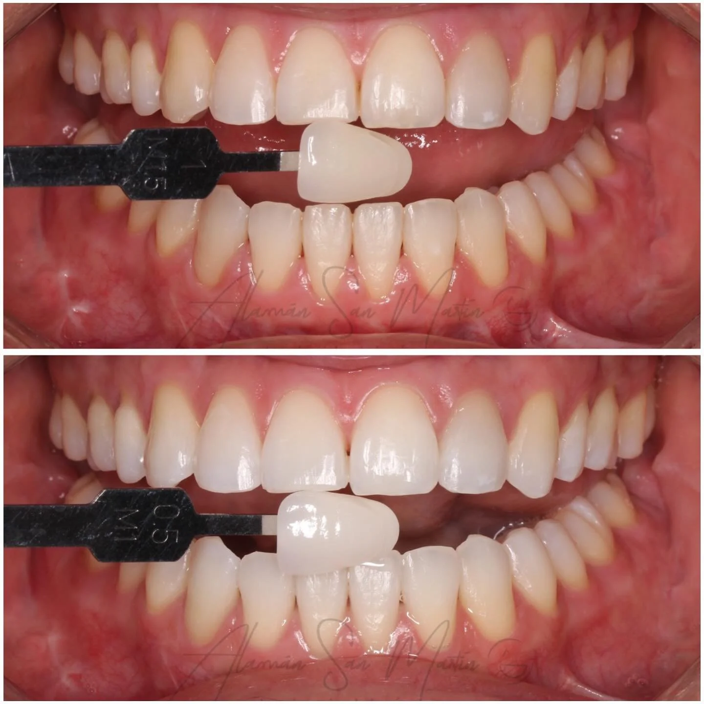 Recupera el blanco natural de tus dientes y si&eacute;ntete seguro ! 🦷🤍

Transforma tu sonrisa con nuestro blanqueamiento dental ! 

☎️ Ponte en contacto con nosotros si est&aacute;s interesado en hacerte este tratamiento ! 912009214