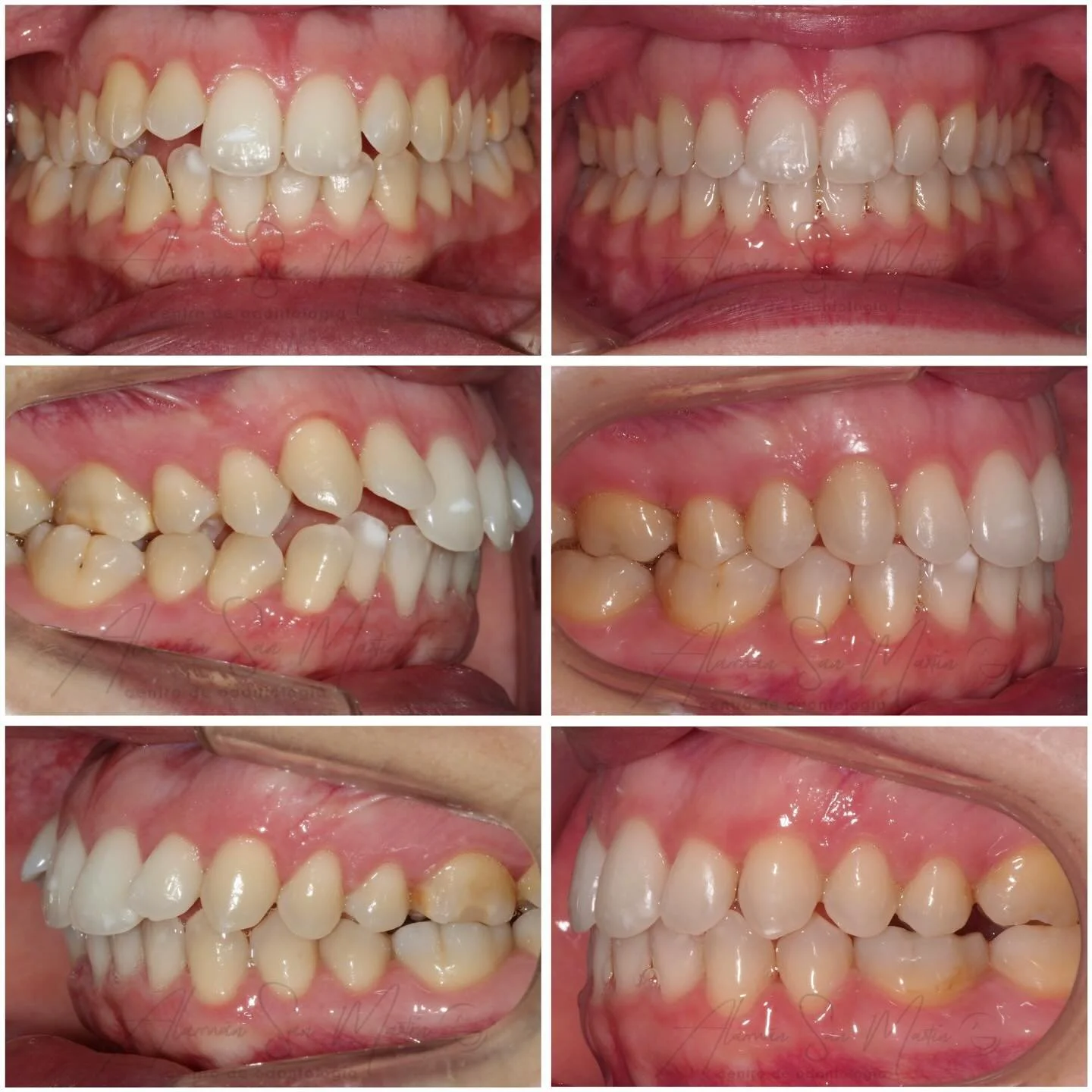 ✨ Sonrisas que cambian vidas ✨
Caso de cirug&iacute;a ortogn&aacute;tica + ortodoncia quir&uacute;rgica = 

✅ Mejor funci&oacute;n 
✅ Mejor est&eacute;tica 
✅ Mejor calidad de vida 

Cirujano Dr. Juli&aacute;n Ruiz 

☎️ Si est&aacute;s interesado en 