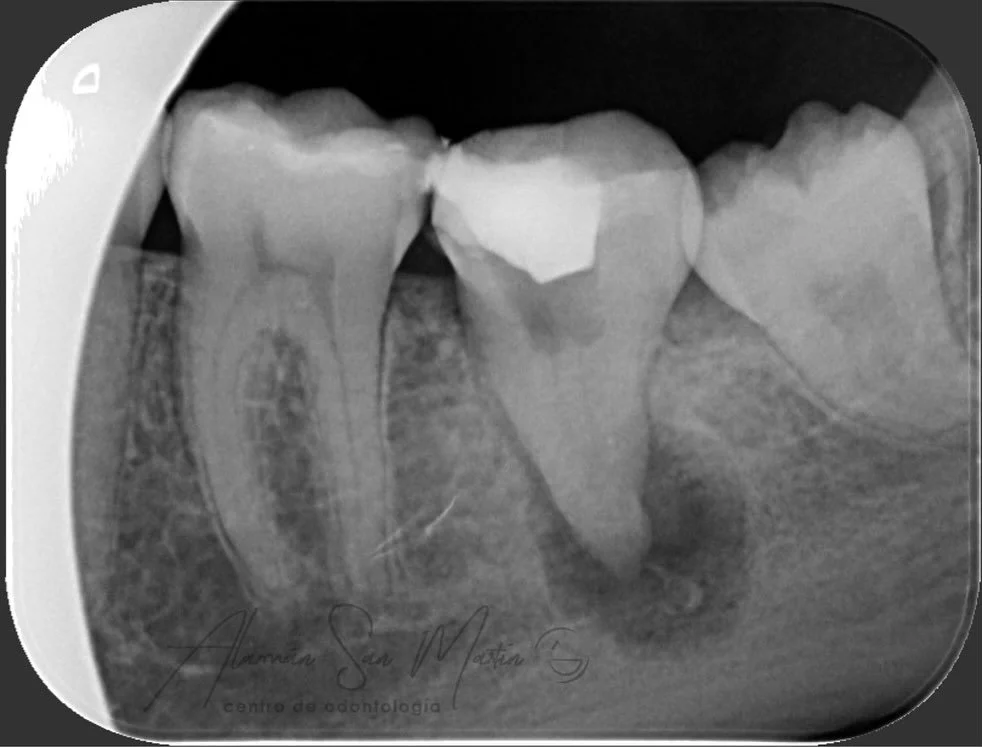 &iquest; Sab&iacute;as que una endodoncia es a veces la &uacute;ltima oportunidad de salvar un dientes antes de perderlo ? 🤔

👨🏻&zwj;⚕️ Recuerda la importancia de acudir a revisiones anuales con tu dentista ‼️

Dra. De El&iacute;o