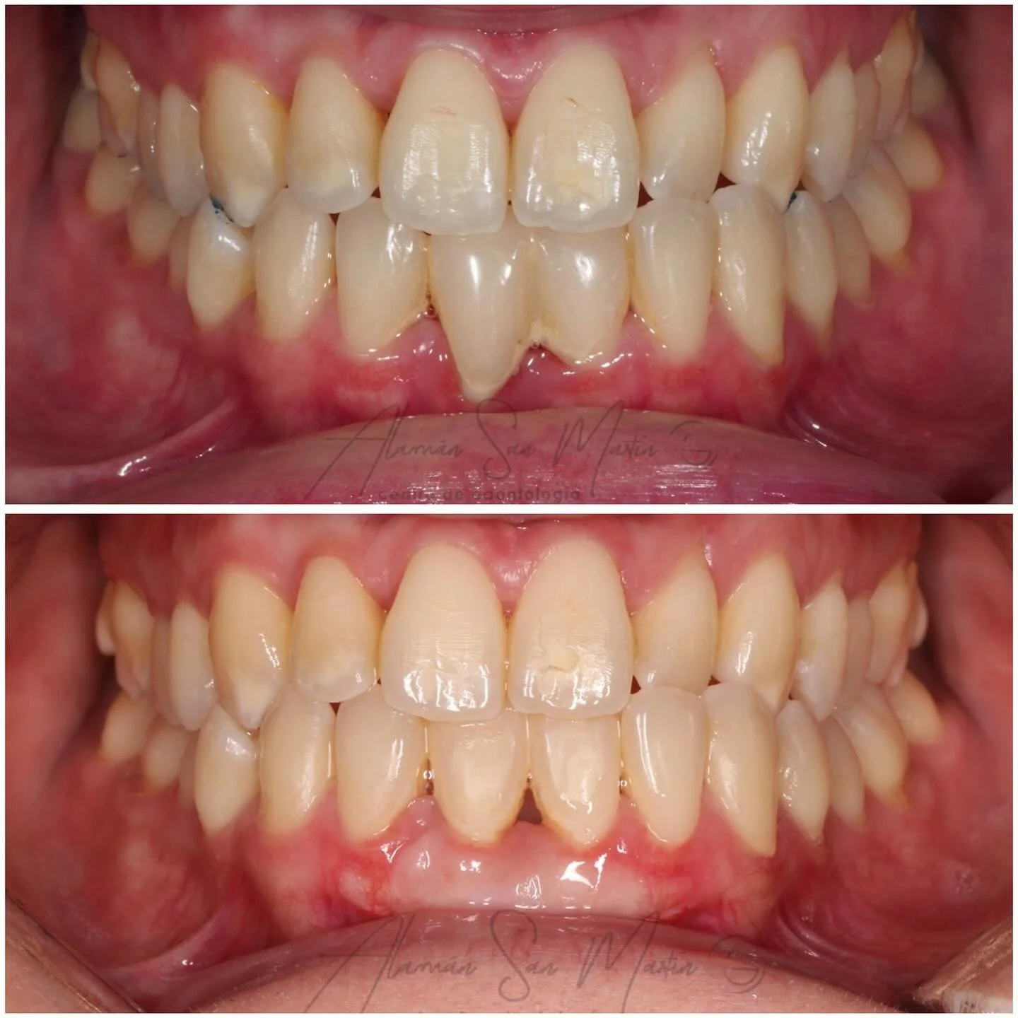 Hoy os traemos este caso tan interesante 🧐 

1- Retiramos carillas sobrecontorneadas con exceso de volumen para mejorar el estado periodontal
2- Carillas provisionales en 3.1-4.1 para posterior tratamiento periodontal 
3- injerto de tejido conectivo