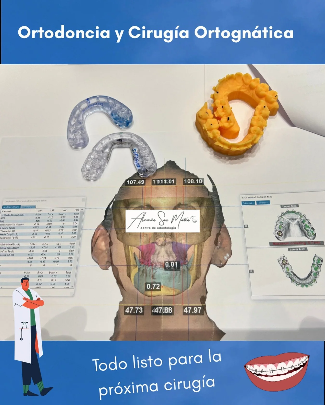 Paciente ya listo para su cirug&iacute;a ortogn&aacute;tica. Planificaci&oacute;n digital 3d en las f&eacute;rulas quir&uacute;rgicas con ajustes oclusales realizados tras la reuni&oacute;n de equipo cirujano-laboratorio maxilofacial-ortodoncista. #o