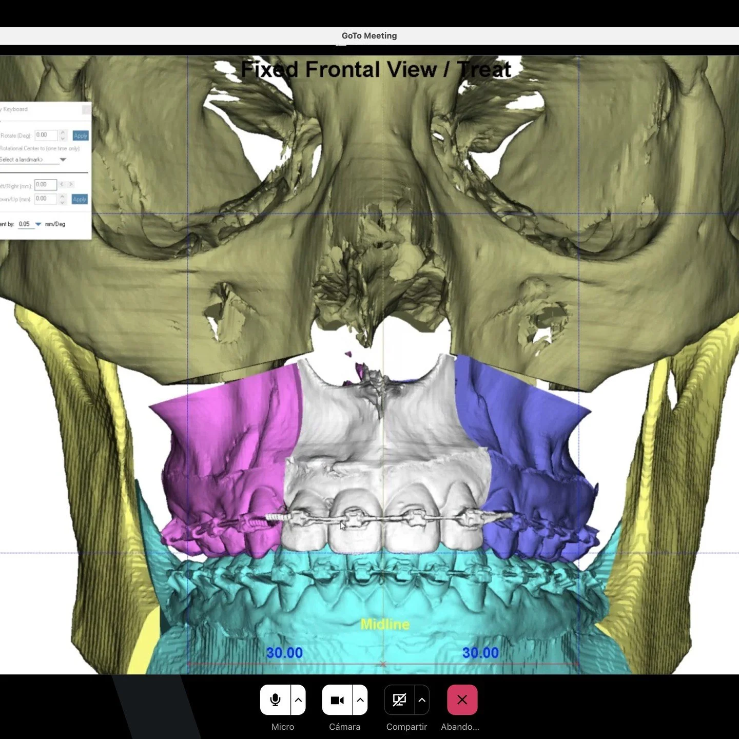 En plena Planificaci&oacute;n 3d de cirug&iacute;a #ortogn&aacute;tica buscando salud con la mejor funci&oacute;n, simetr&iacute;a, armon&iacute;a facial, y los objetivos del paciente. Paso a paso con protocolo de trabajo y buen resultado final con c