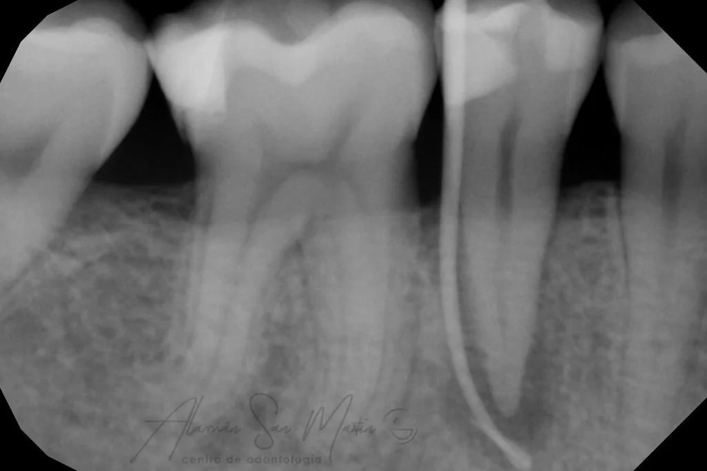 En la primera imagen observamos una fistulometr&iacute;a, procedimiento el cual usamos para saber el origen del la infecci&oacute;n 🤕

La segunda imagen corresponde al d&iacute;a de la endodoncia 🤔

Y para terminar tenemos una imagen donde podemos 