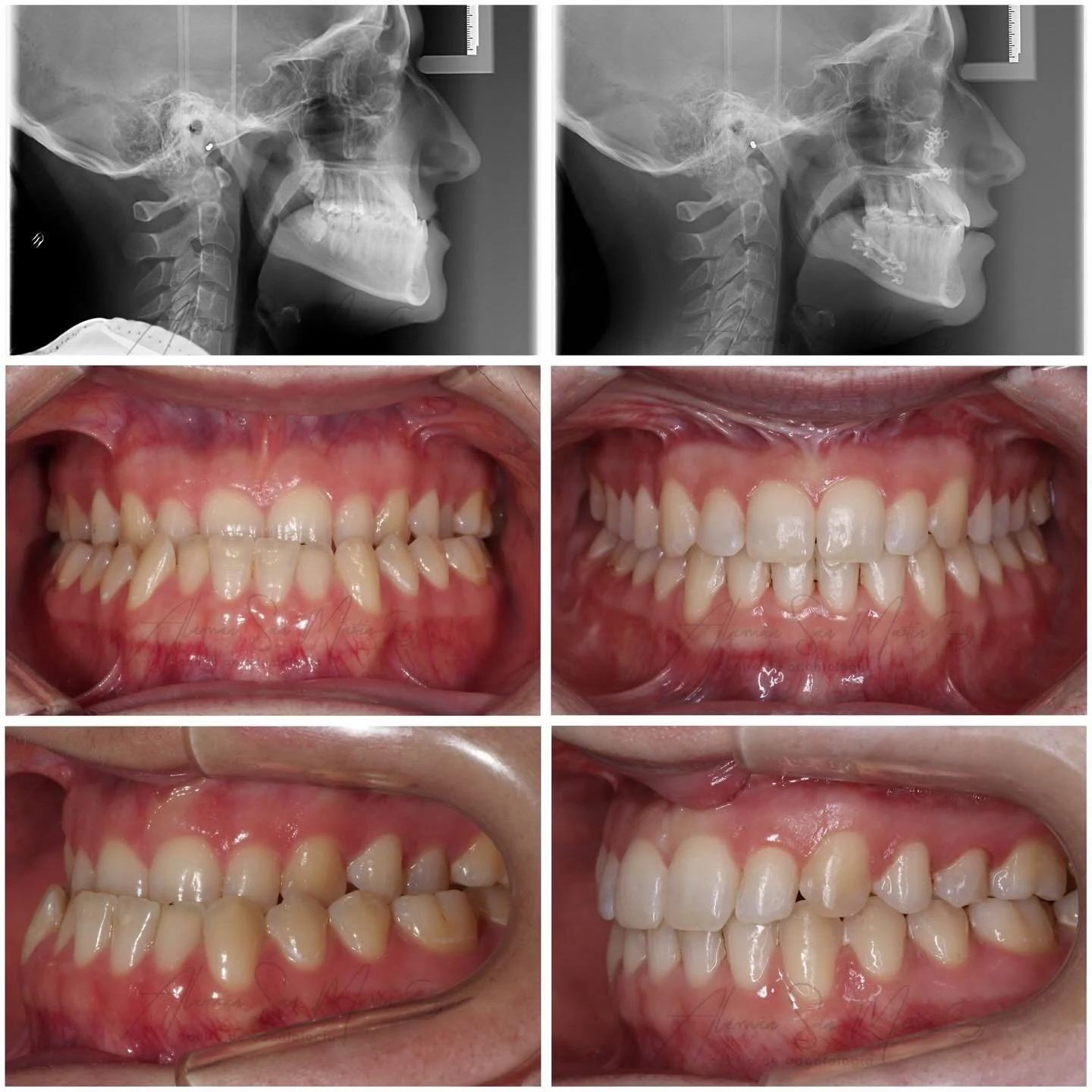😁 Este es el resultado de un tratamiento de ortodoncia junto con cirug&iacute;a ortogn&aacute;tica de un paciente con clase III esquel&eacute;tica y mordida cruzada.
Nos encanta veros sonre&iacute;r !!! 🤪🫱🏼&zwj;🫲🏽

Cirujana Laura Colorado Cogol