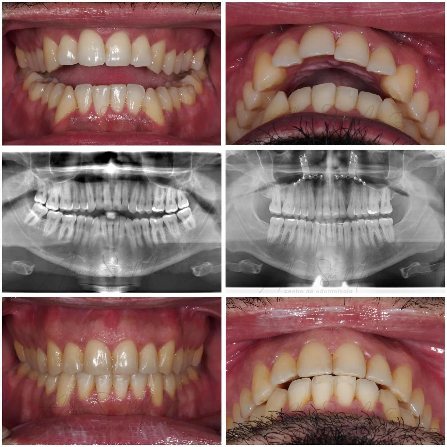 🦷 Nuestro paciente presentaba una mordida abierta, lo que imped&iacute;a que los dientes anteriores contactaran correctamente.

Tras un tratamiento combinado de ortodoncia quir&uacute;rgica  y cirug&iacute;a ortogn&aacute;tica, conseguimos cerrar la