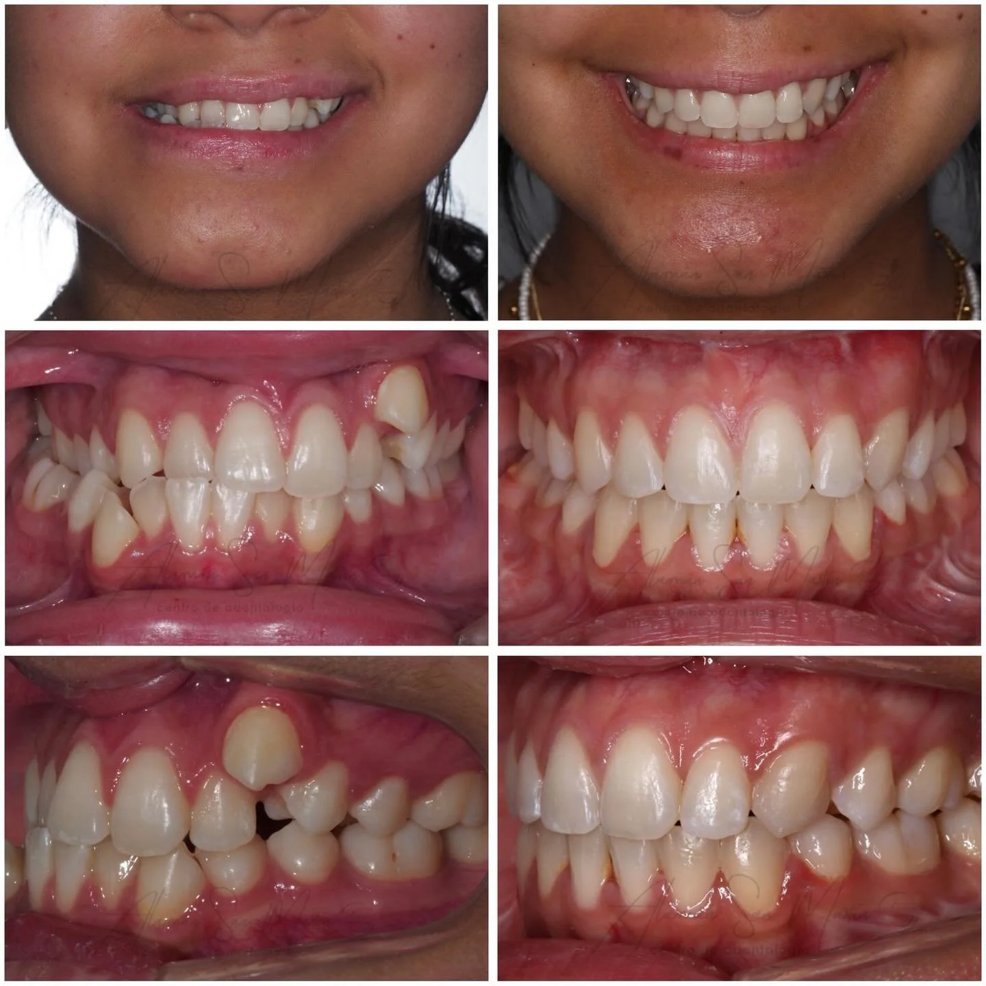 Hoy os mostramos un nuevo caso de ortodoncia y cirug&iacute;a ortogn&aacute;tica : Paciente con maloclusi&oacute;n de Clase III, compresi&oacute;n, api&ntilde;amiento y desviaci&oacute;n mandibular que hemos preparado en colaboraci&oacute;n con el Dr