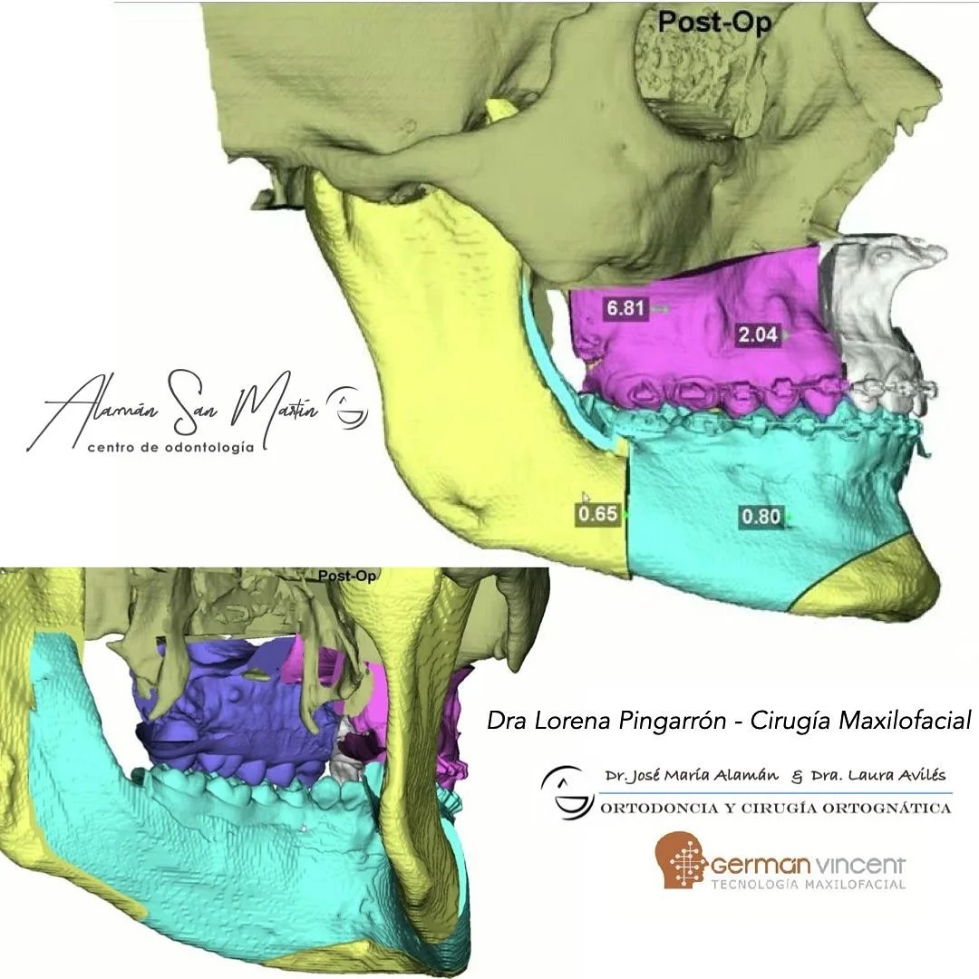 Cirug&iacute;a Ortogn&aacute;tica planificada en equipo cirujano, ortodoncista y prot&eacute;sico con un buen diagn&oacute;stico y medici&oacute;n del paciente. Gracias a la Dra Pingarr&oacute;n y a Germ&aacute;n Vincent junto al Dr Alam&aacute;n y l