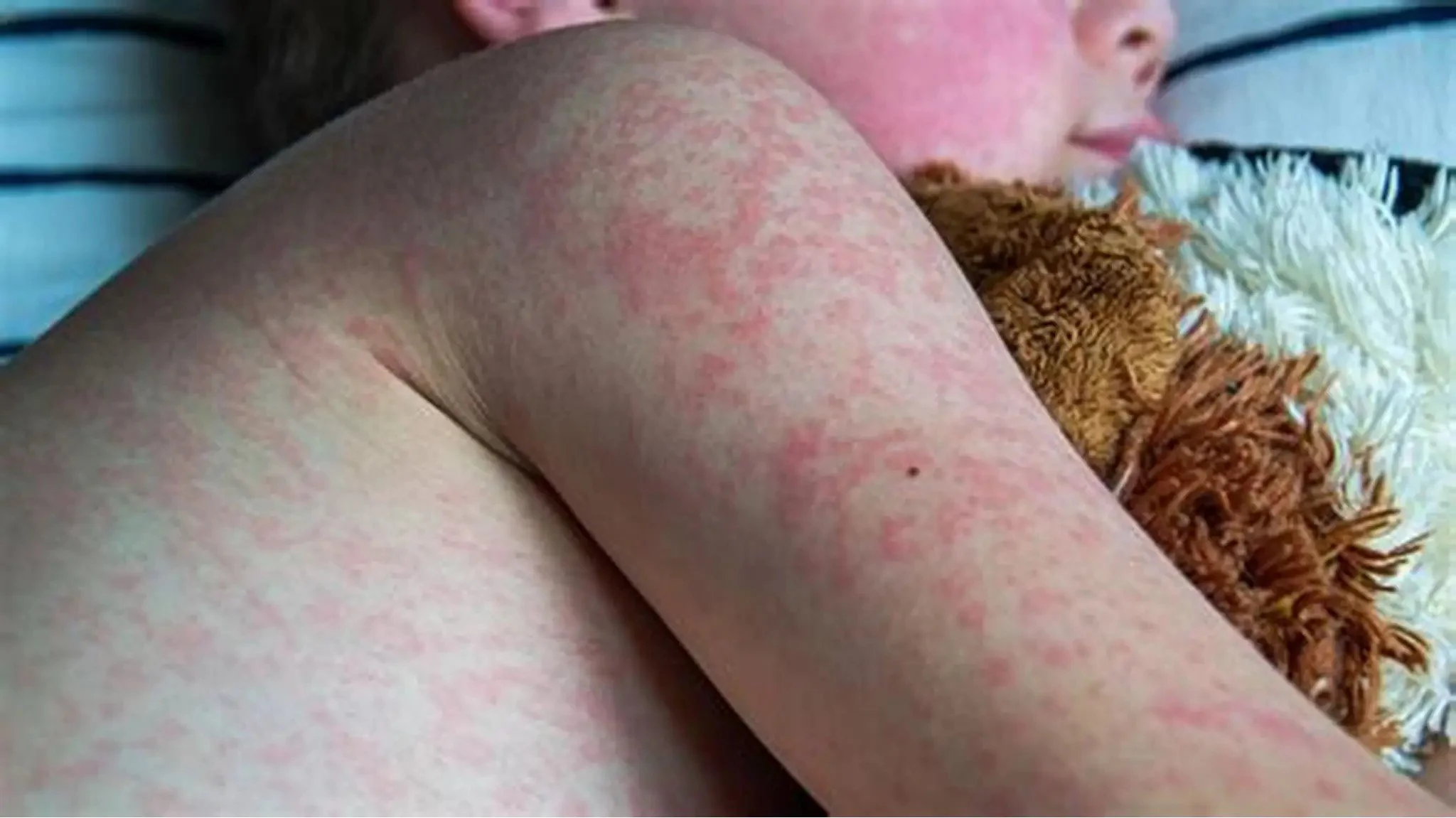 Parents urged to ensure children are vaccinated against measles