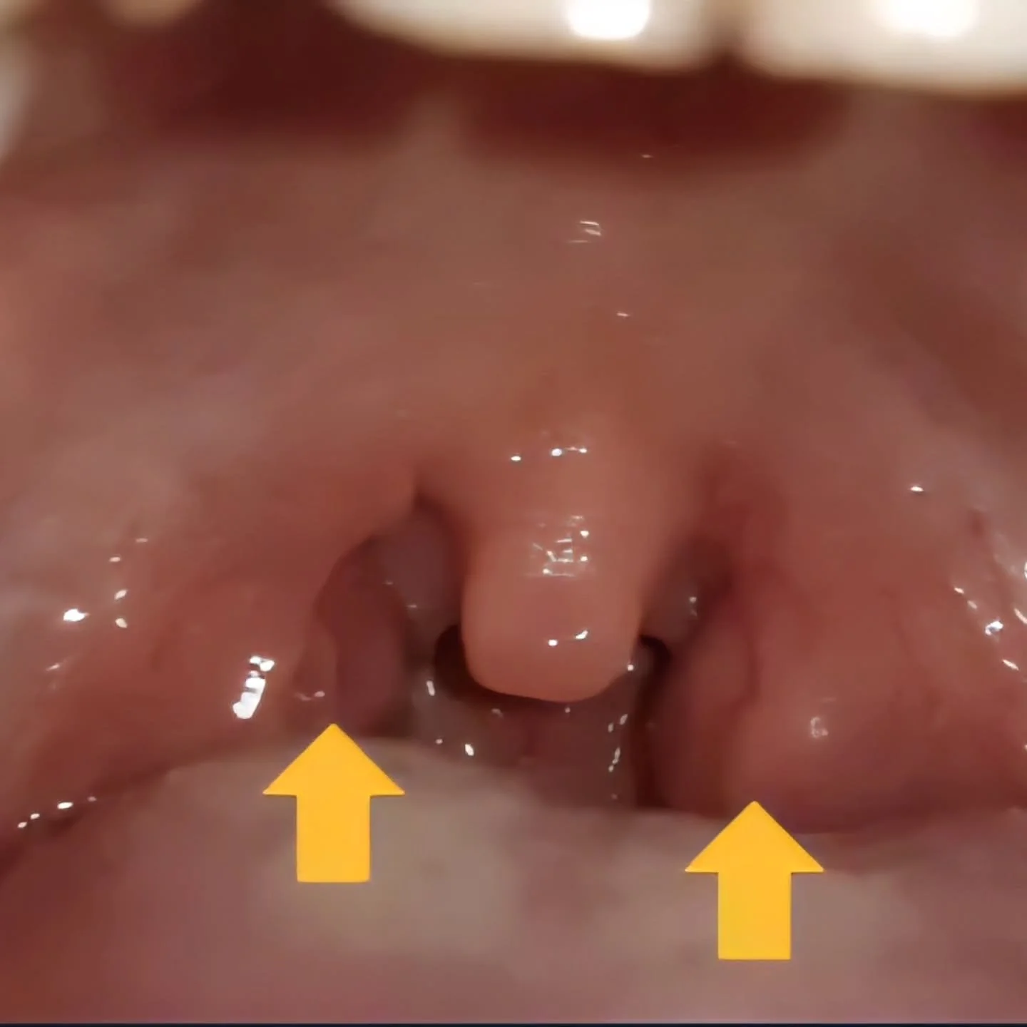 🌬️ Did you know enlarged tonsils are often a symptom, not the root problem?

When tonsils are chronically enlarged, it&rsquo;s usually the body waving a red flag 🚩 that there may be underlying mouth breathing and airway issues.

👃 A healthy airway
