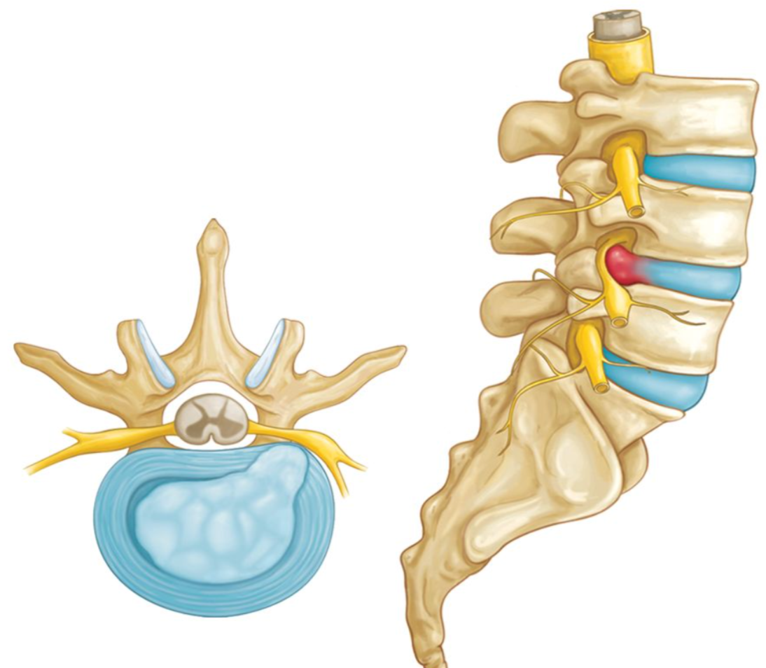 Lumbar spine injury diagram showing disc and joint stress after car accident