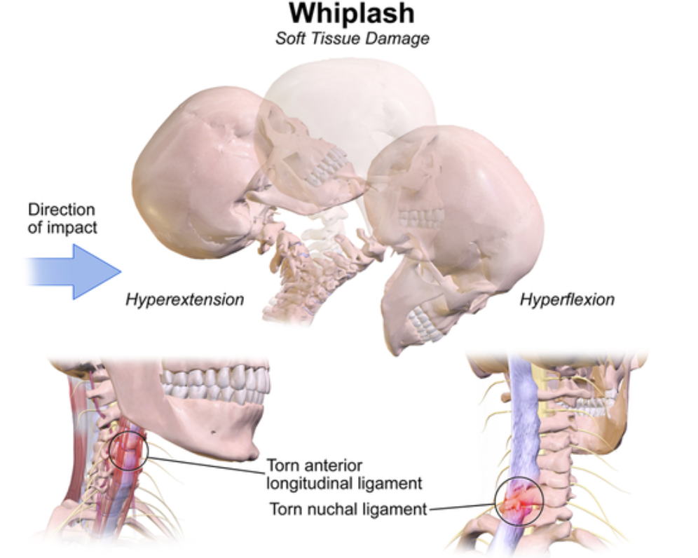 Whiplash cervical spine injury diagram showing neck hyperextension and flexion