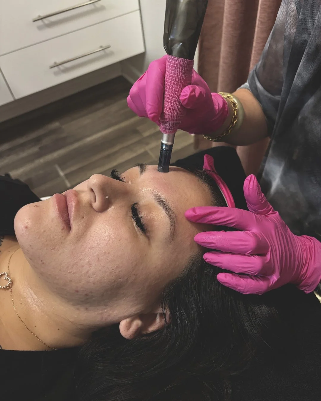 Microneedling with SkinPen at Oh Aesthetics: What It Is and What It Can Do for Your Skin