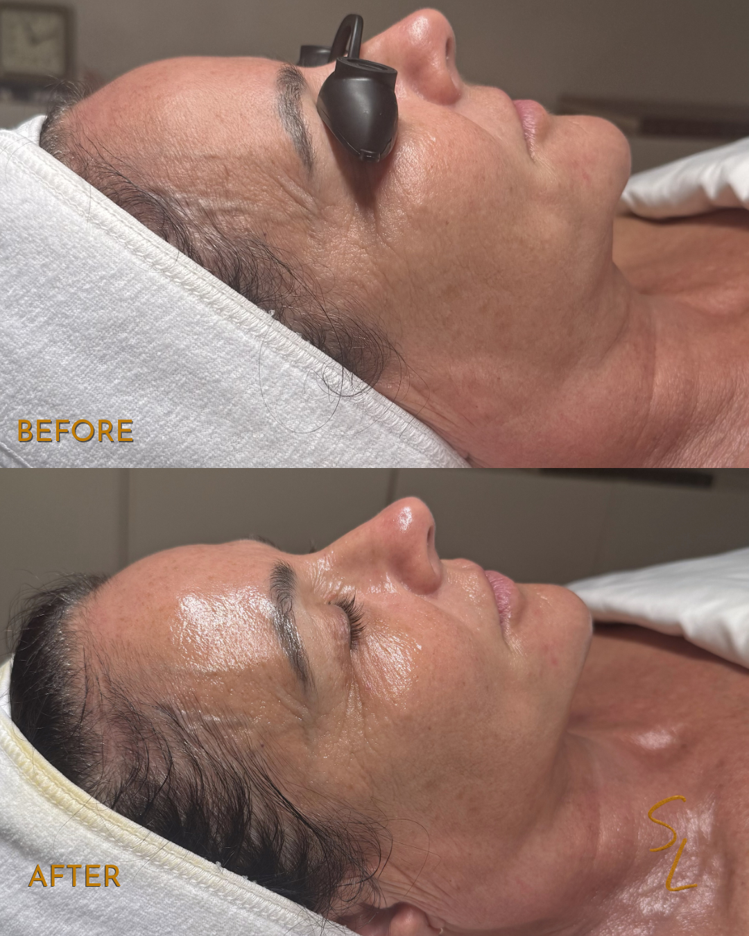 Side-by-side comparison of a woman's face before and after a skincare treatment, showing smoother, more lifted and more radiant skin after the procedure.
