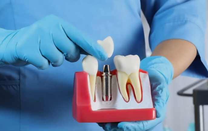 Your Guide to Dental Implants at Applecross House