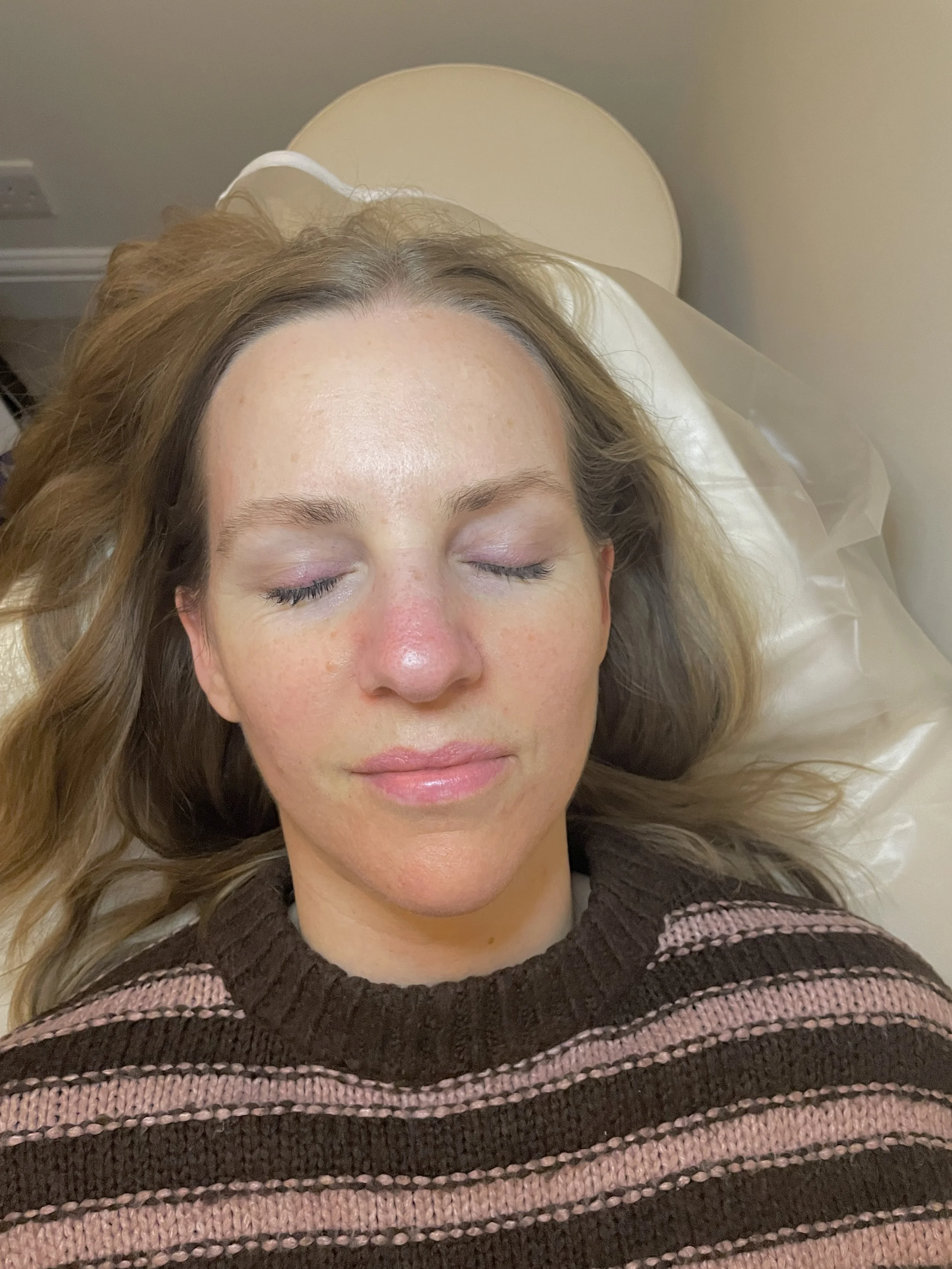 A woman with closed eyes lying on a medical examination bed with a white pillow, wearing a dark and pink striped sweater.