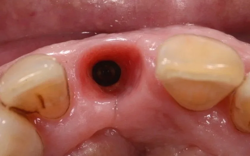 Perfil de emergencia