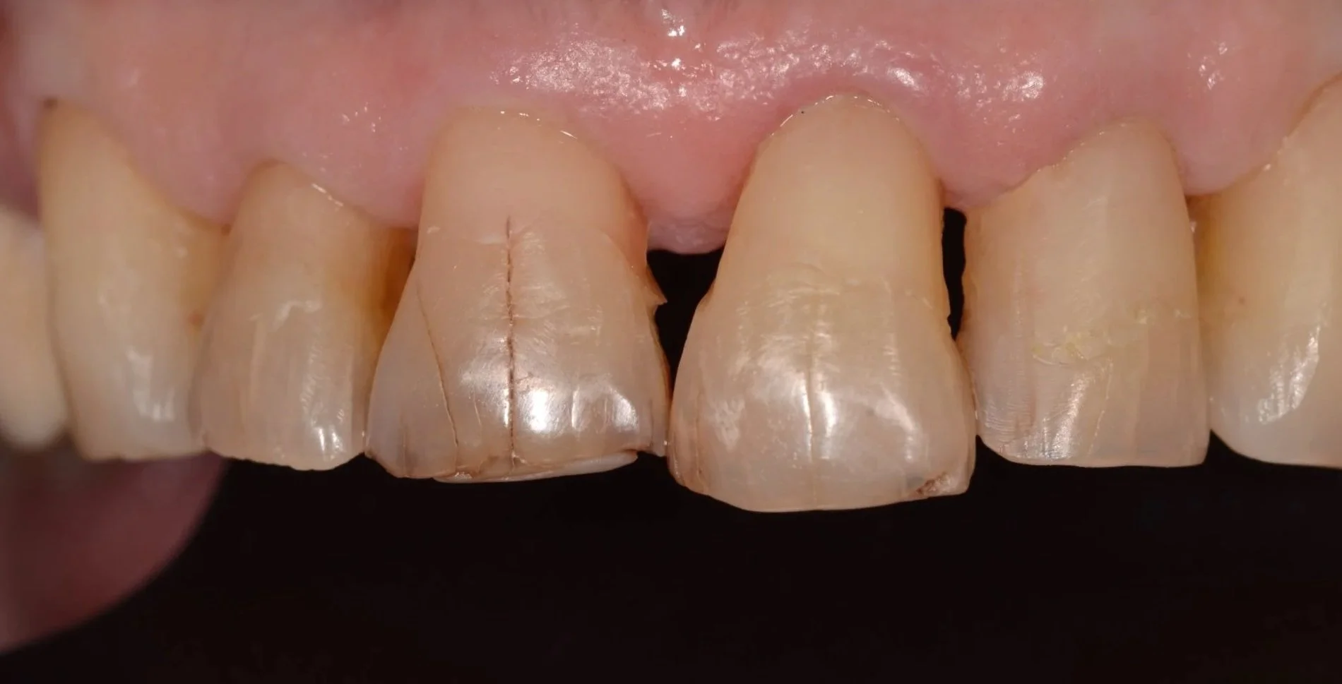 Eliminación de caries y restauraciones