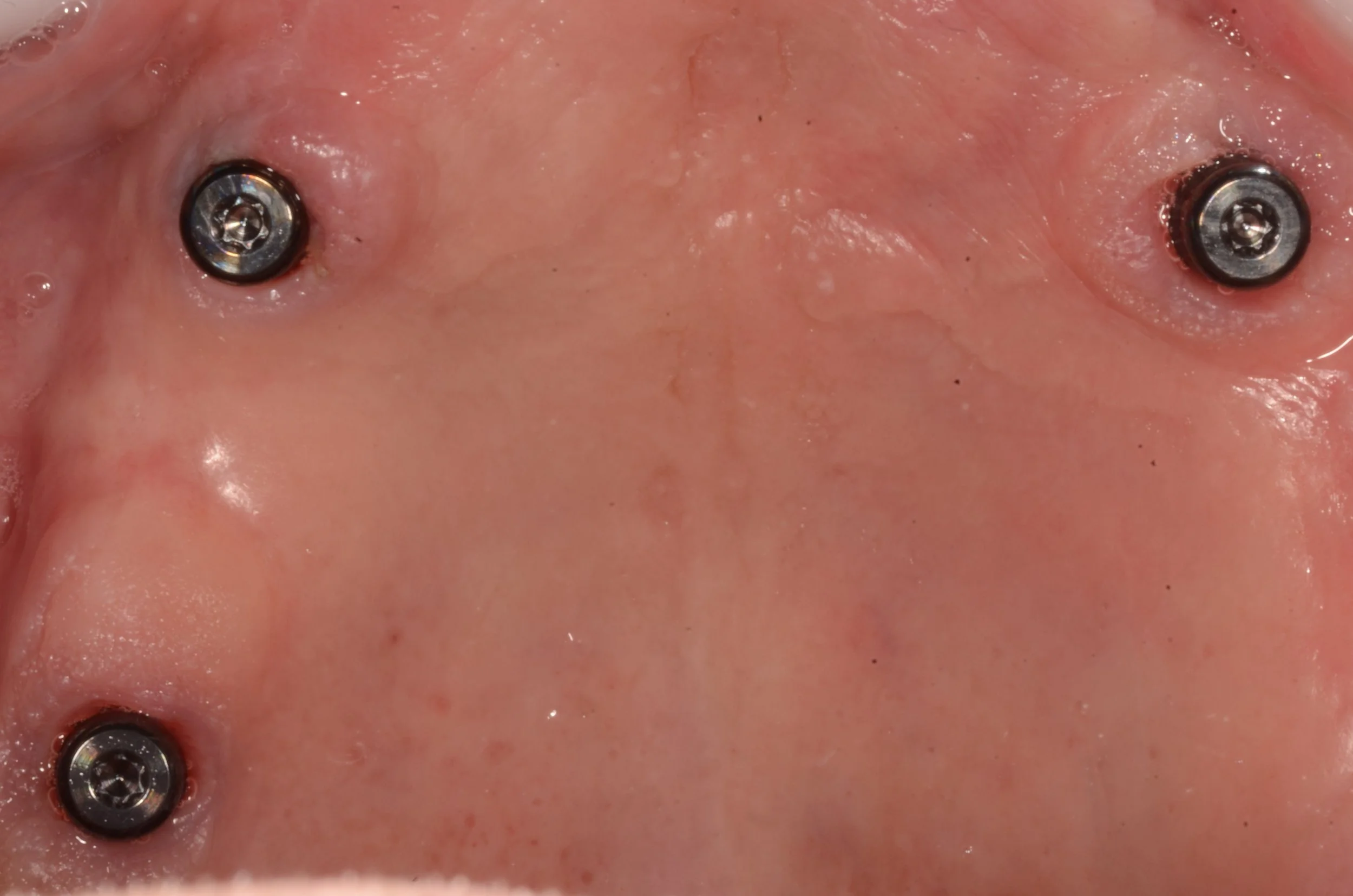 Implante con pilares Novaloc®