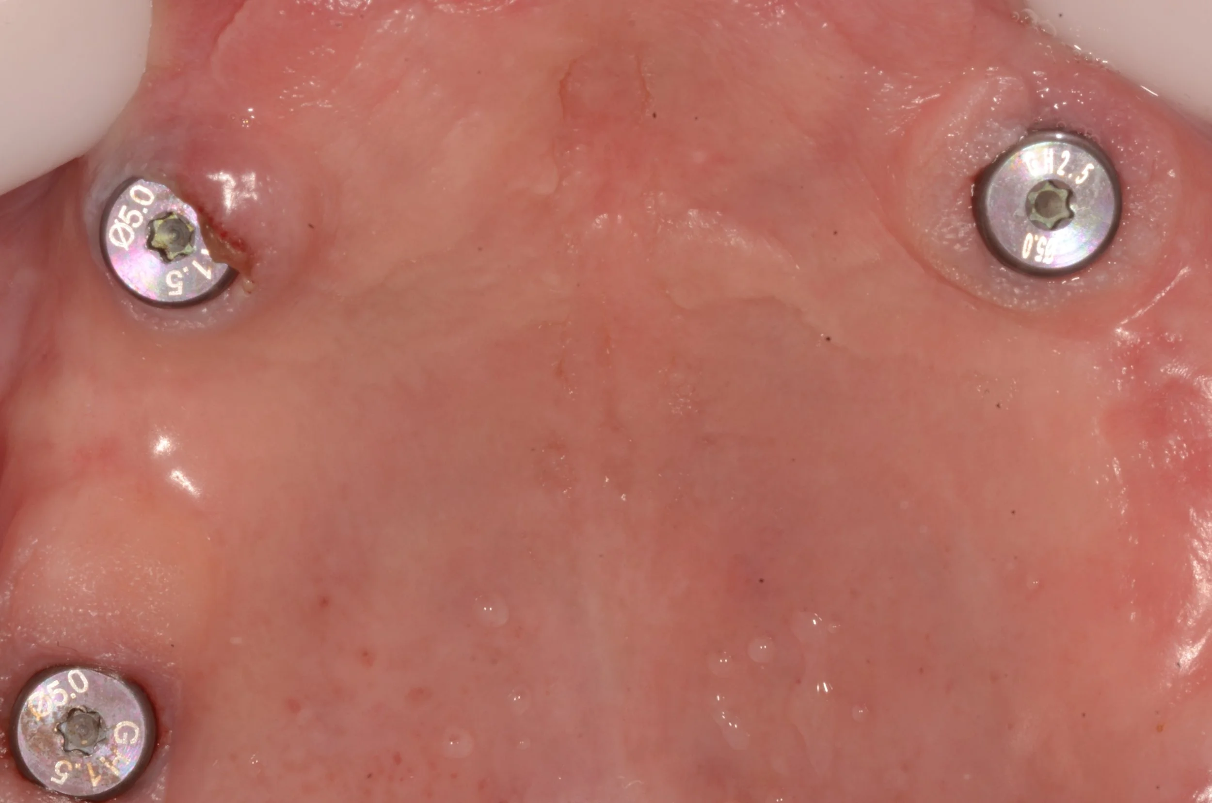 Control a los 2 meses