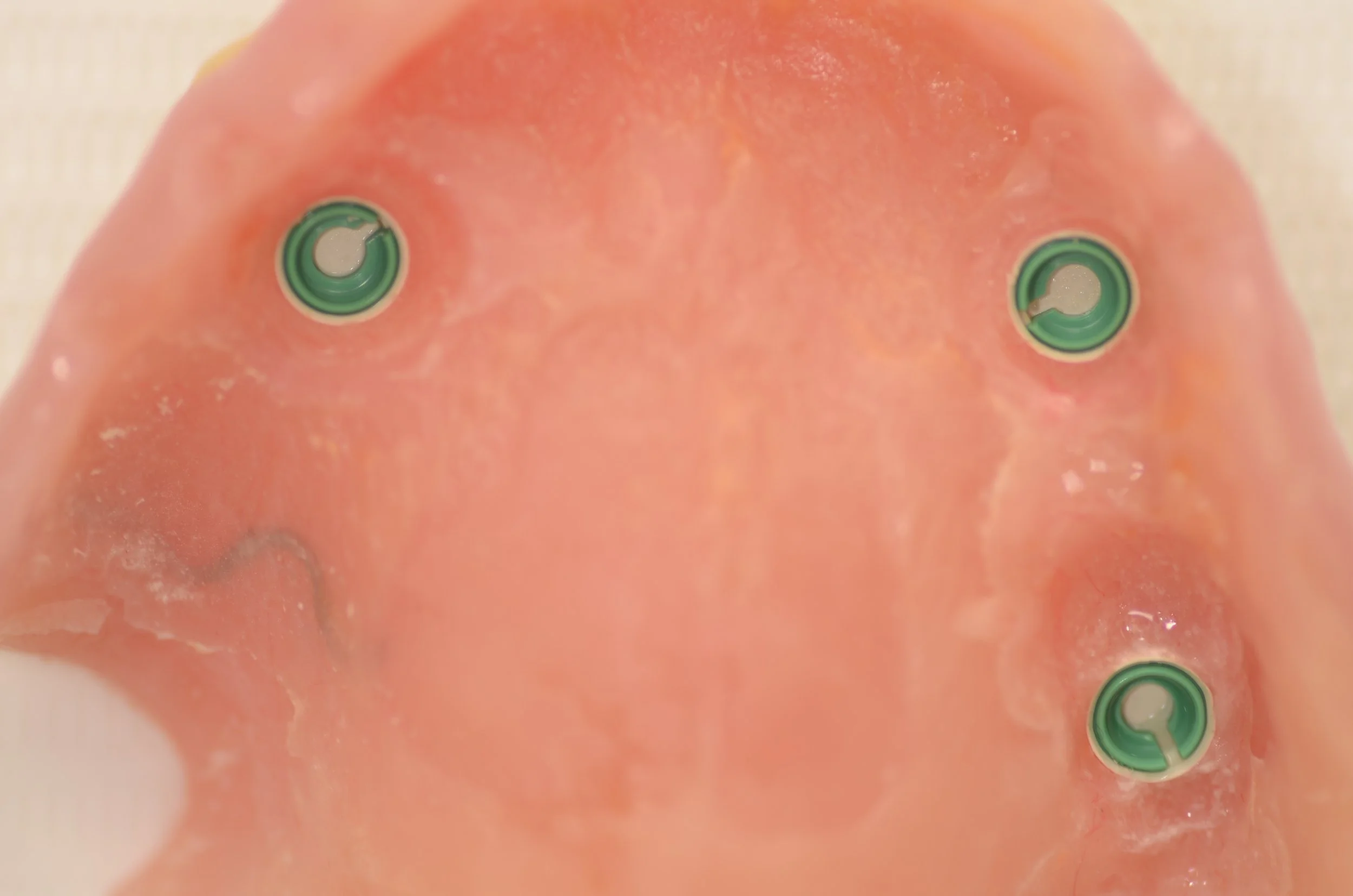 Prótesis con Novaloc® inserto de retención verde (fuerte) 