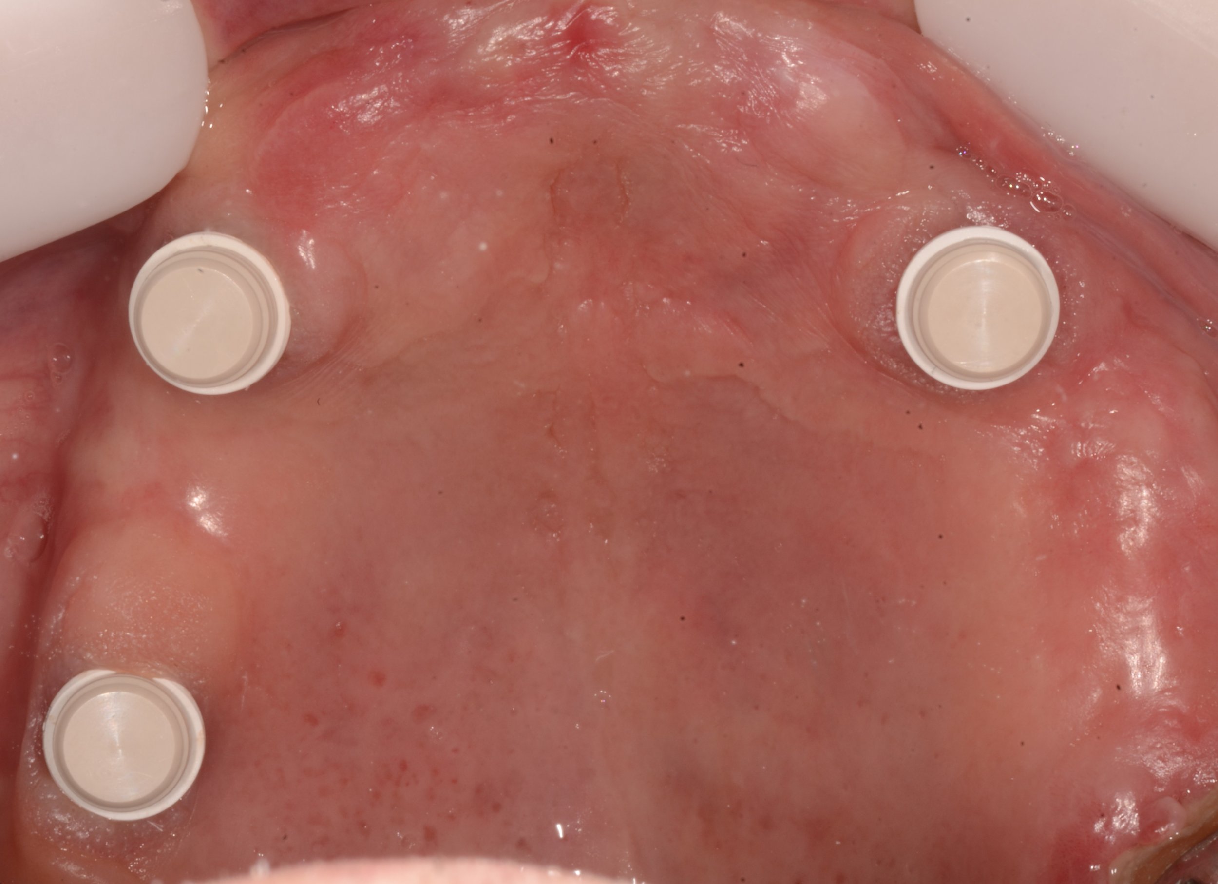 Novaloc® Cáscara de Matriz