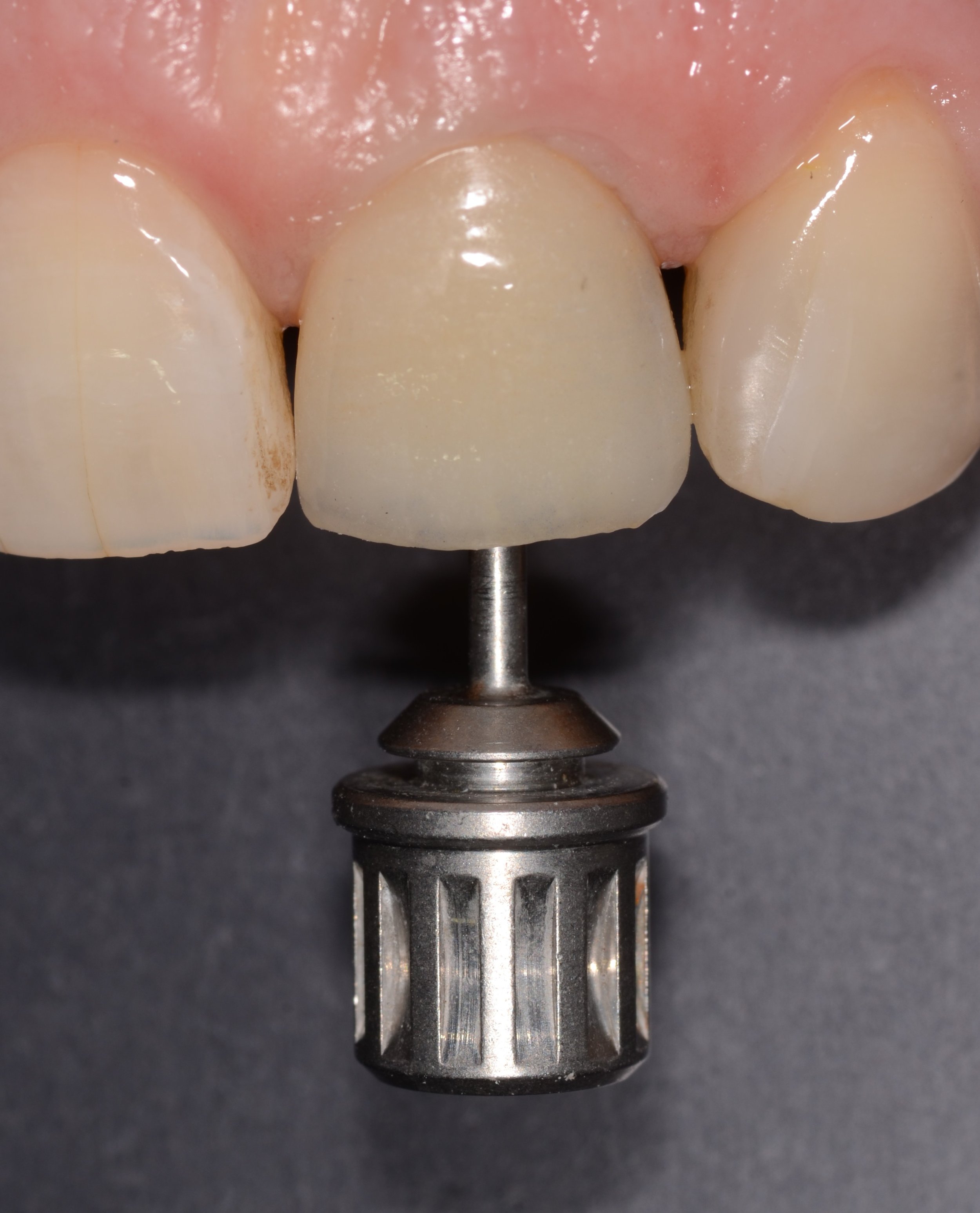 Prueba de adaptación de corona