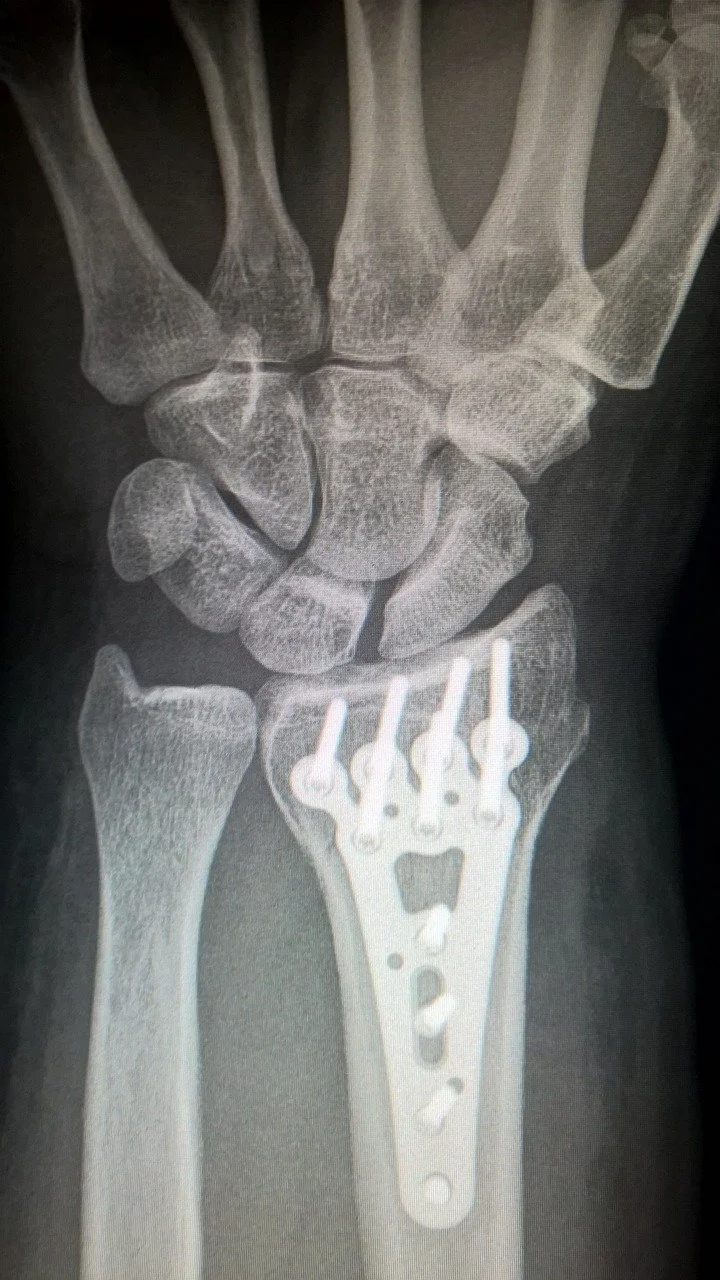 Fracture in Circleville? What to Do When the ER Visit Isn’t Enough