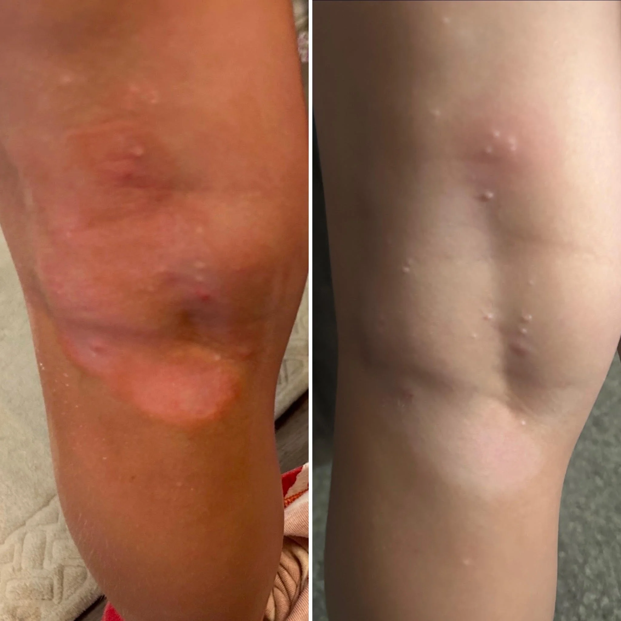 When cortisone failed, nature stepped in
-
3 days of G.G.’s Remedies and the skin is healing beautifully!