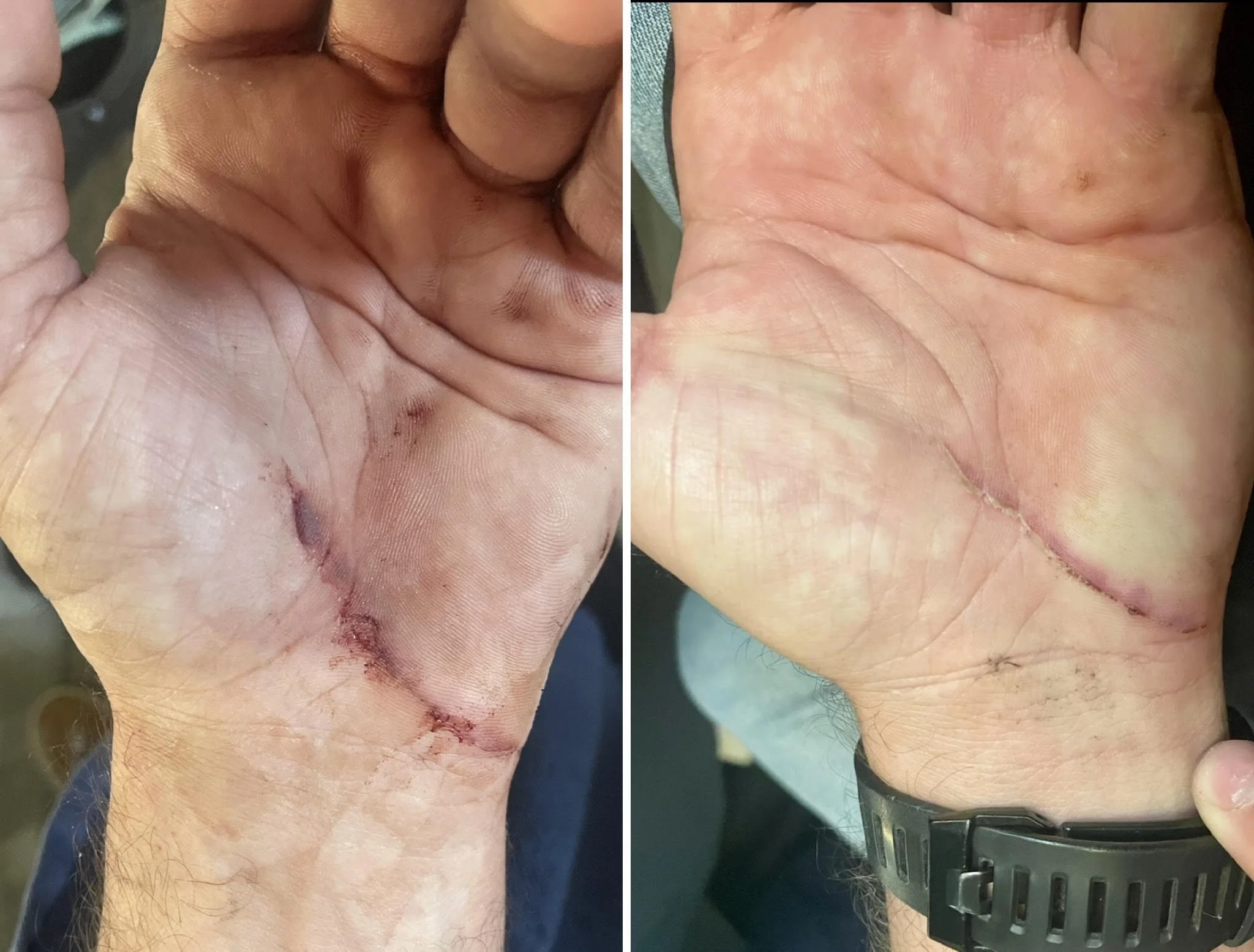 He sliced his hand, and after just 2 days of using Bites, Burns & Boo-Boos, the wound showed significant healing—fast, gentle, natural, and safe for both people and pets.