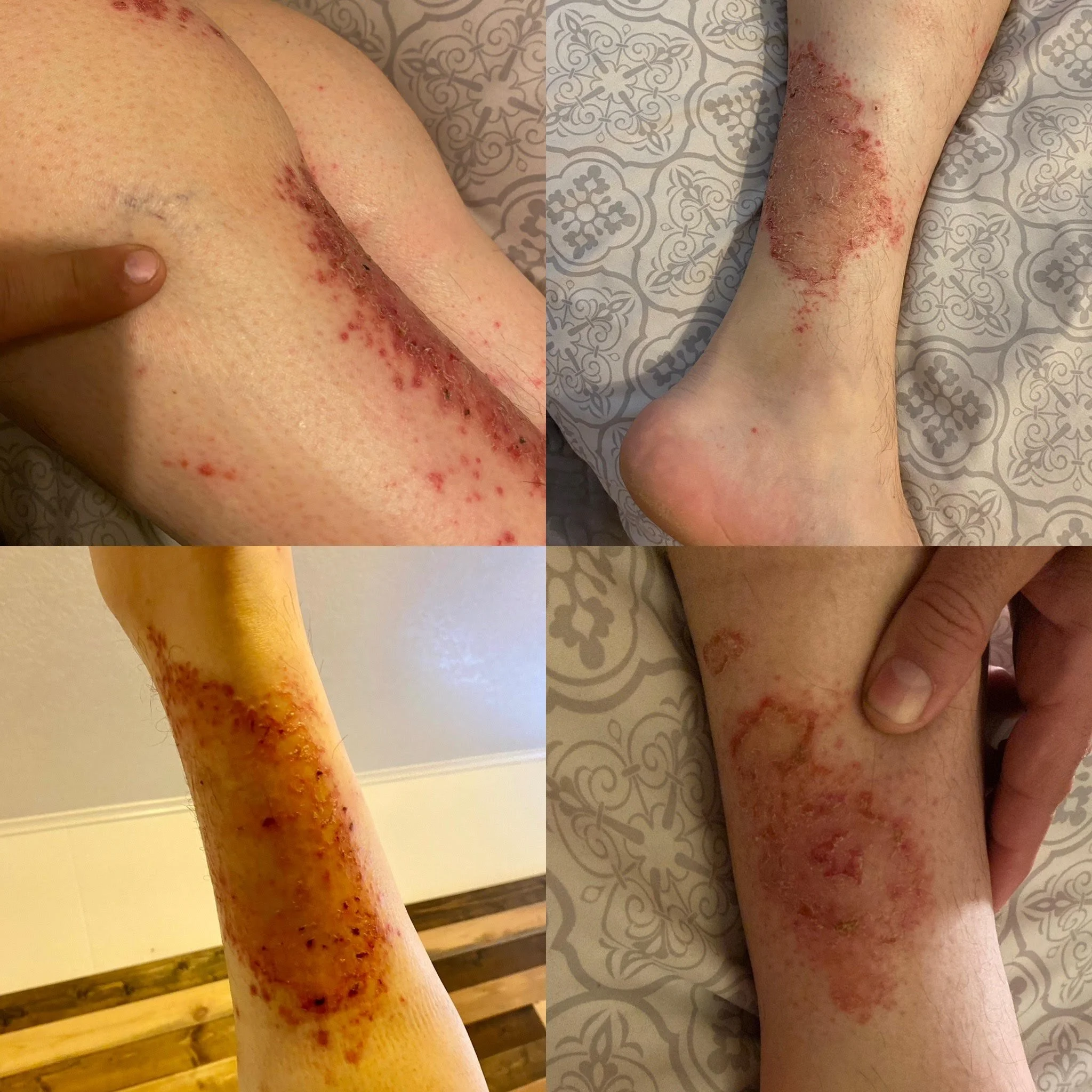 Before: Severe, painful, and itchy eczema with noticeable scarring.
