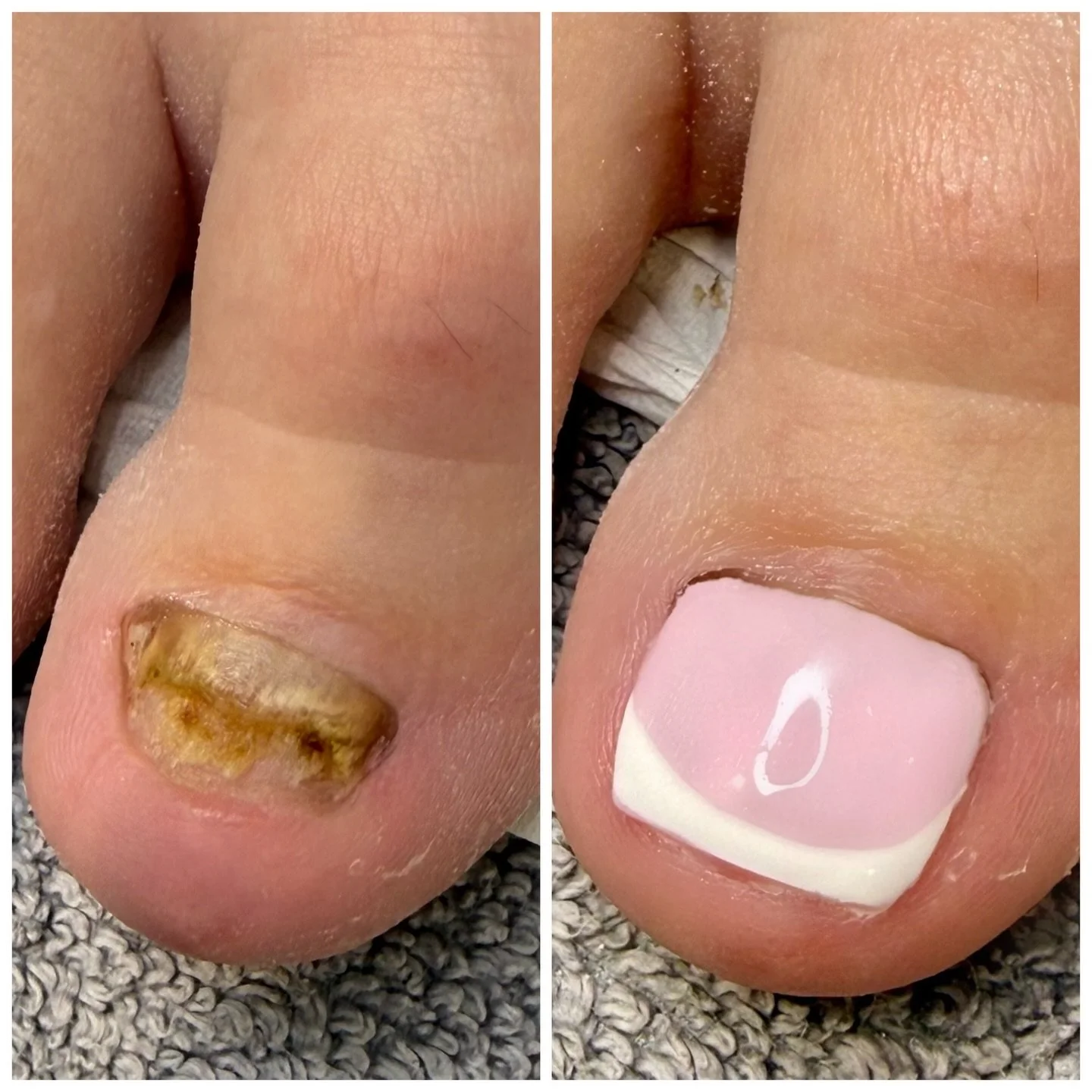 ✨ LCN Toenail Reconstruction ✨
A specialised treatment designed to help restore the look of damaged or missing toenails.

Perfect if you have:

* Nail trauma
* Damaged or uneven nails
* Partial nail loss 

The nail is carefully prepared and then rebu