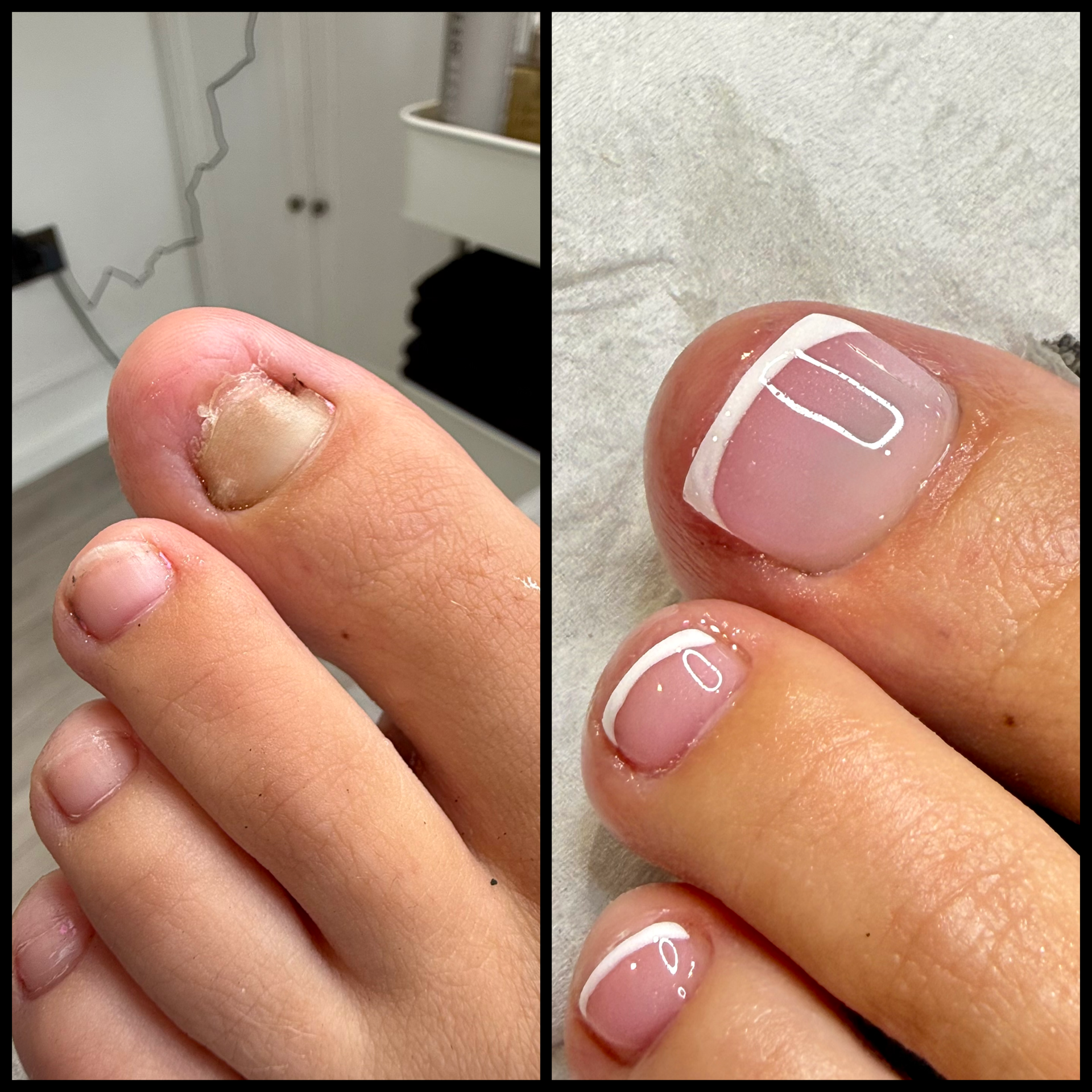 Before and after LCN Wilde Pedique toenail reconstruction showing cosmetic restoration of a damaged toenail in Woking.