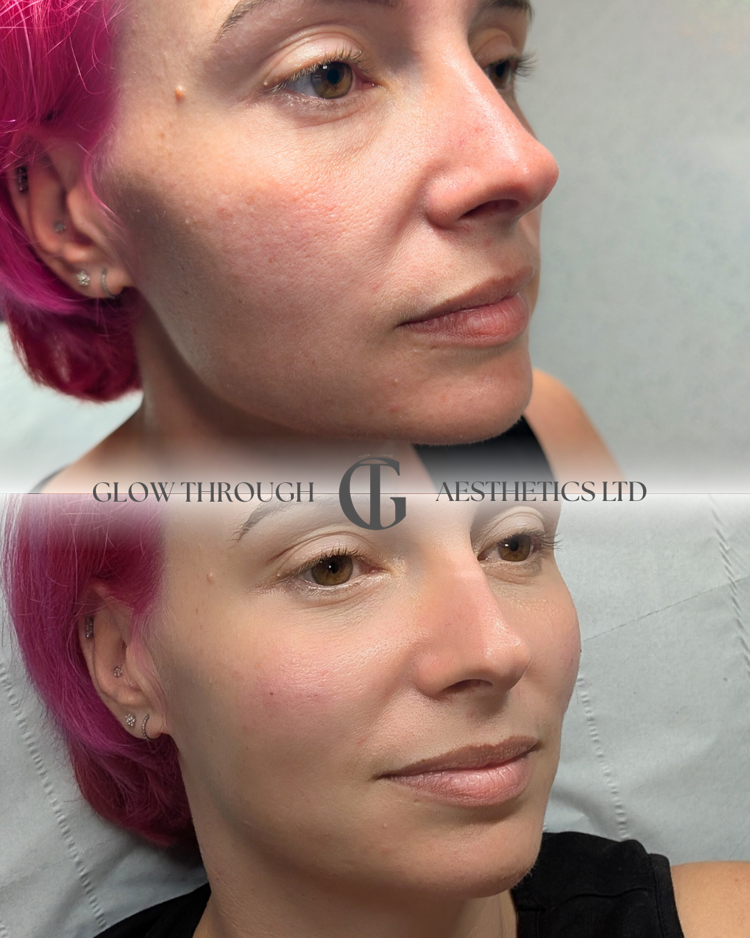 Cheek filler (apple of cheek filler) in our Basingstoke clinic