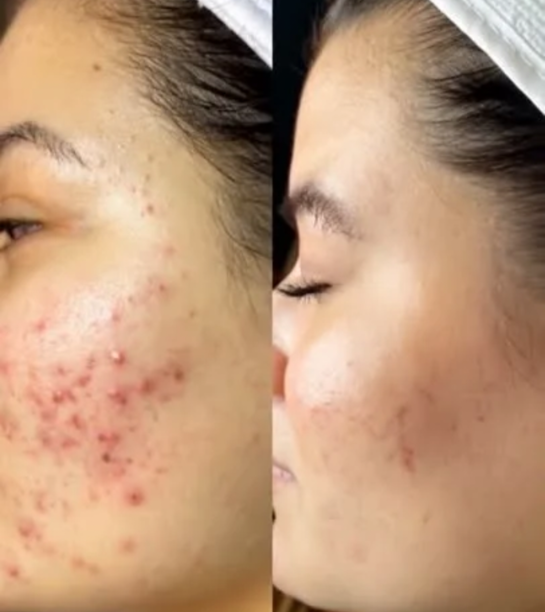 Acne Treatment at Glow Through Aesthetics Basingstoke.