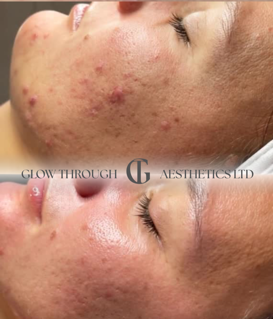 Acne treatment after a skincare course at Glow Through Aesthetics Clinic, Basingstoke.