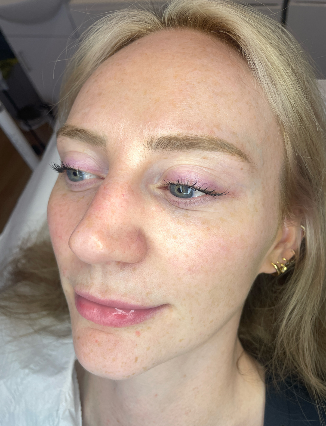 Dermaplaning at Glow Through Aesthetics, Basingstoke. Get that pre event glow with our dermaplaning and deluxe dermaplaning facials.