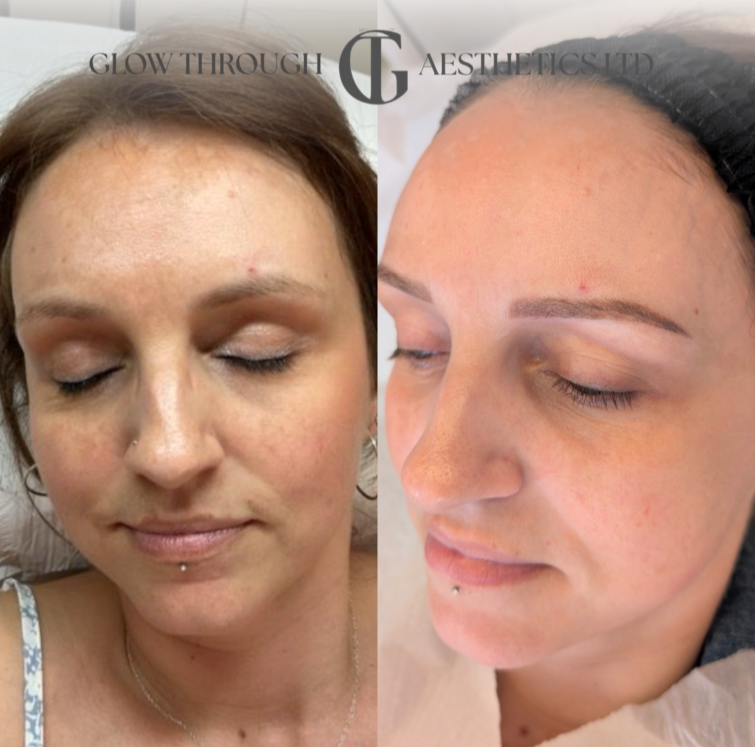 Pigmentation treatment at our basingstoke clinic. Chemical peels for pigmentation.