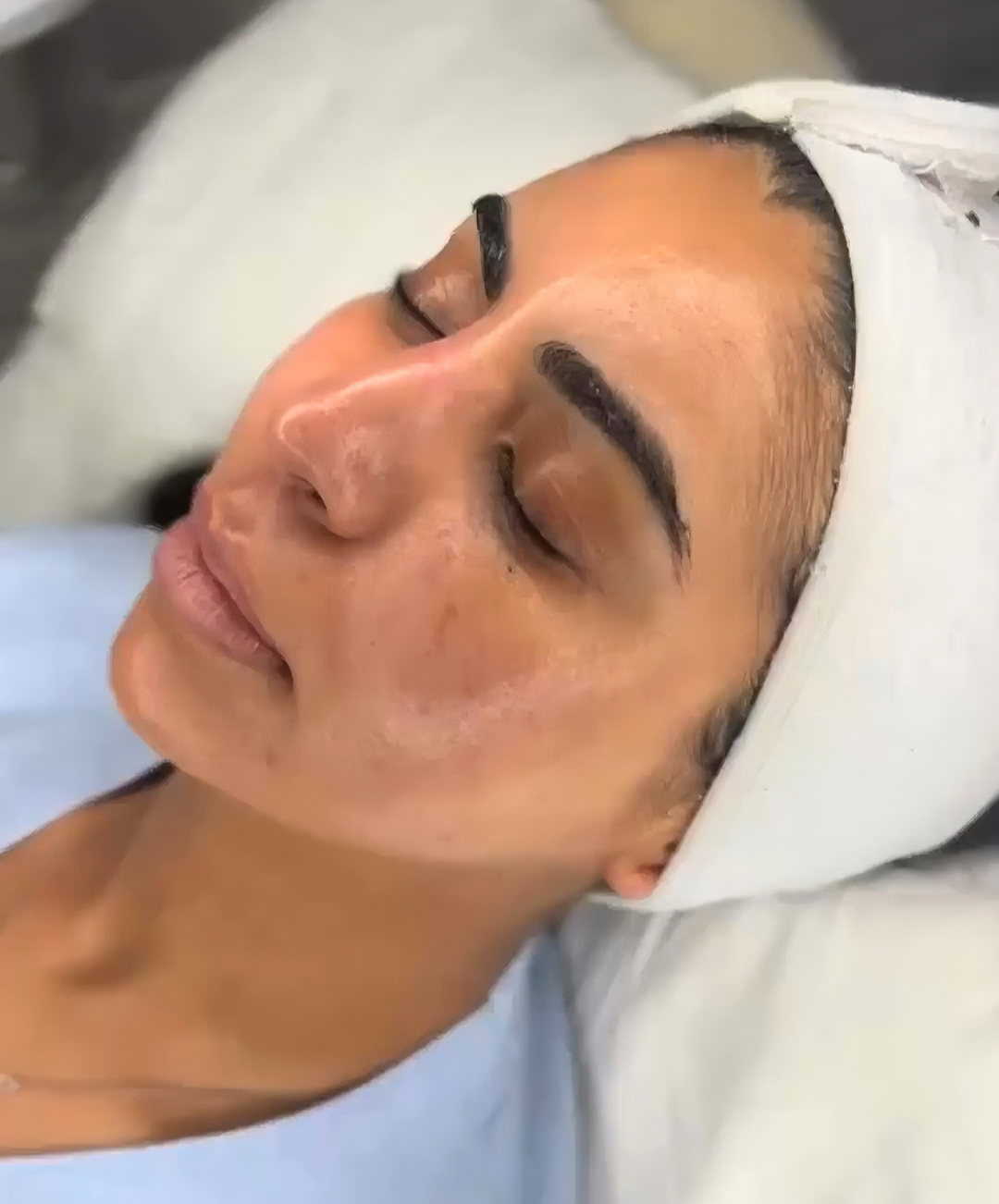 Deluxe dermaplaning in our Basingstoke clinic. Glass skin at glow through aesthetics